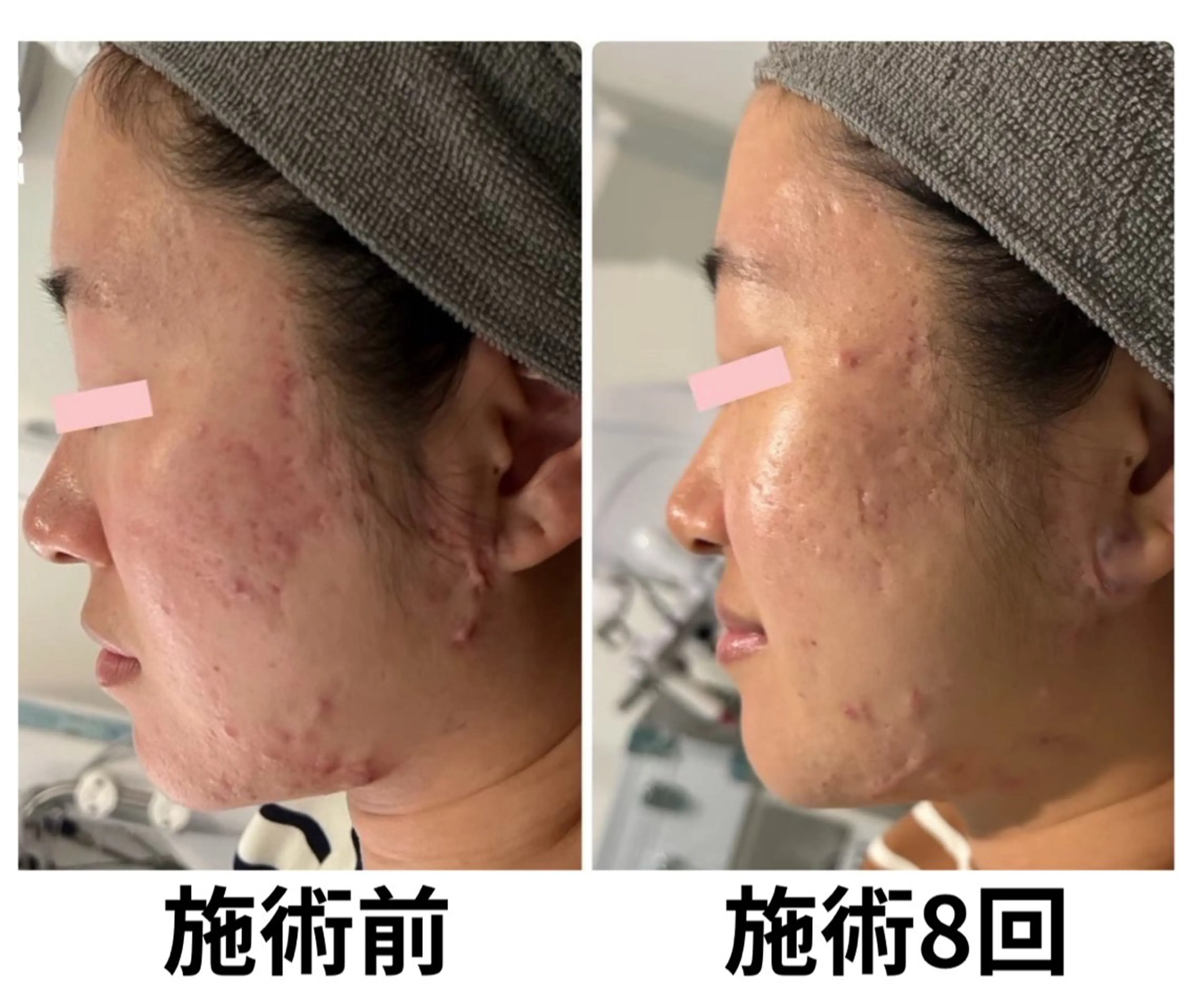 フェイシャルエステサロン 　グレースティー所属・毛穴・ニキビ専門 エステグレースティーのエステ・リラクイメージ