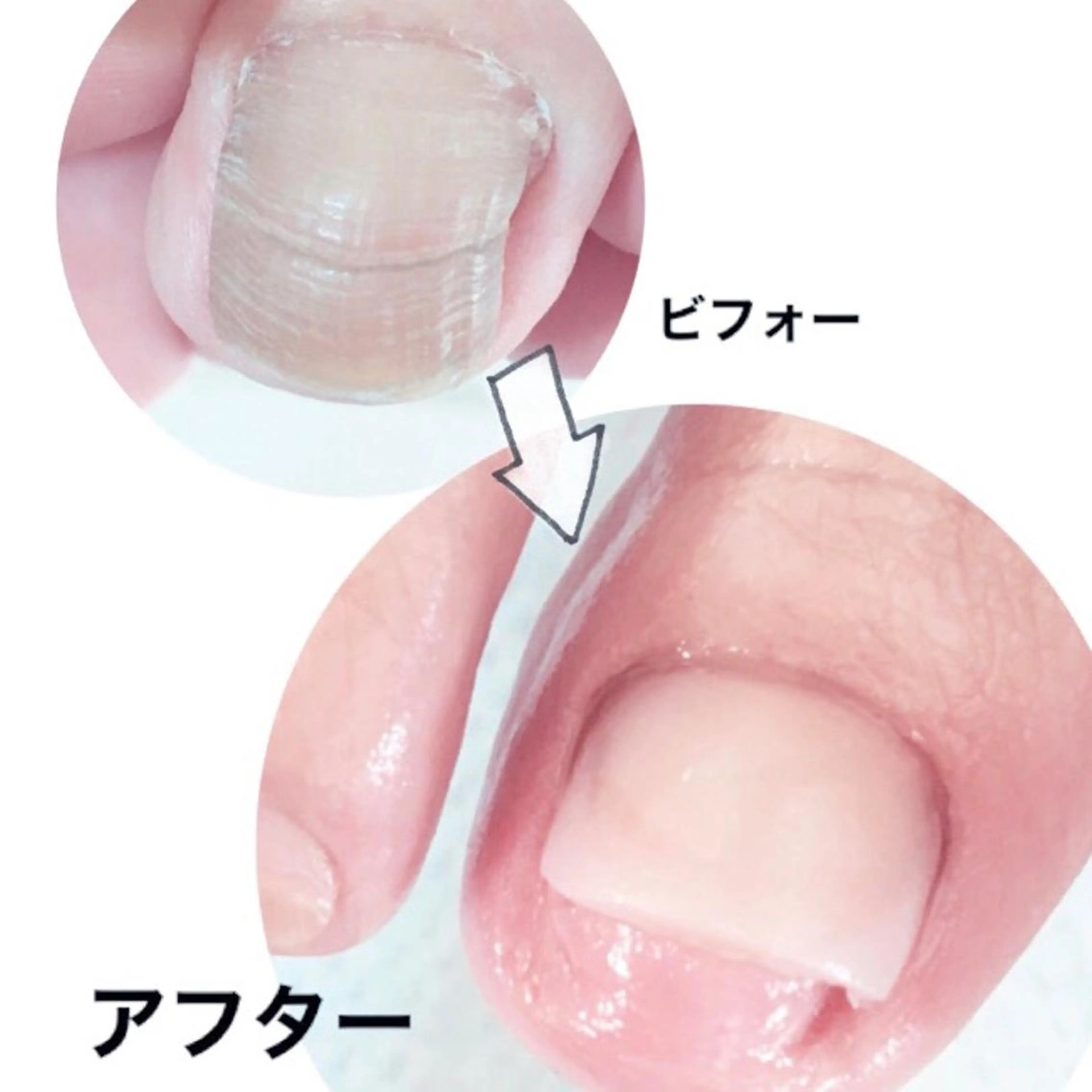 ☆フットのお悩み☆ トラブルネイルケア（1箇所）巻き爪ケア 陥入爪、肥厚爪、深爪の方へ丁寧なケアの写真