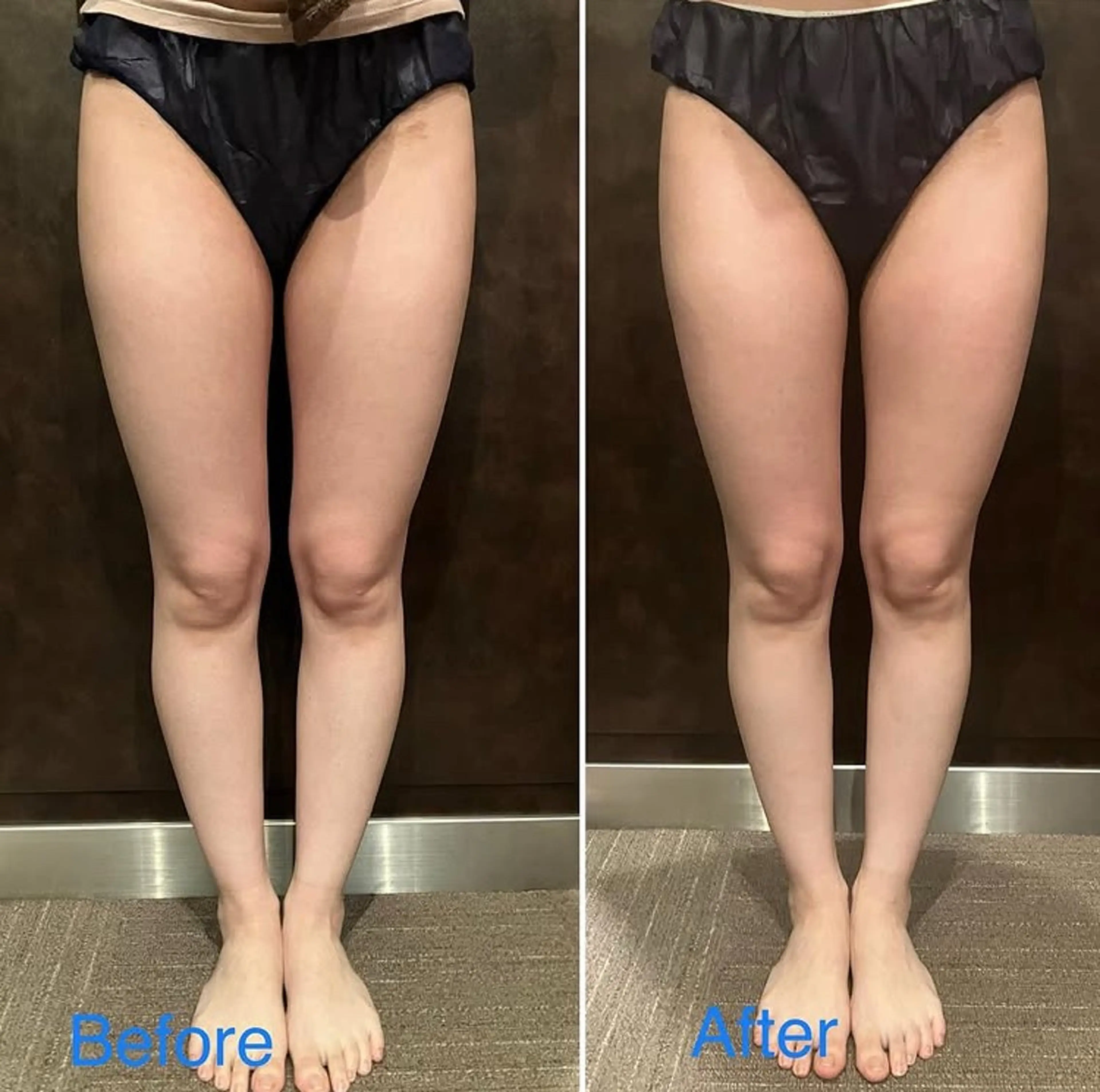 【キャビゼロ】40分　下半身✨気になるボコボコやむくみを除去！理想の美脚への写真