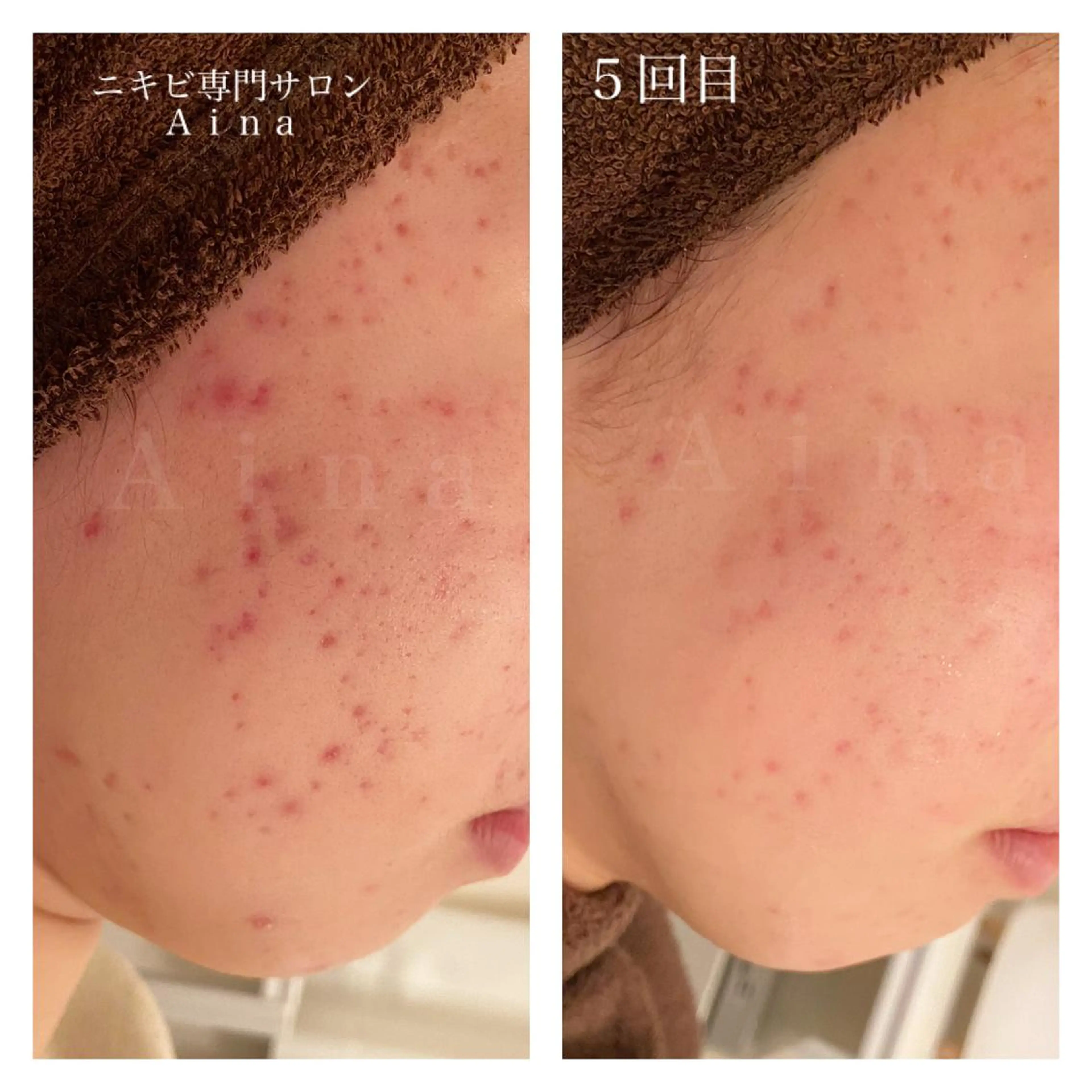 ミディアム カラー パーマ ヘアアレンジ メンズ キッズ ネイル マツエク・マツパ 学生（メンズ向け） 学生 エステ リラク ニキビ跡専門サロン Ａｉｎａのエステ・リラクイメージ