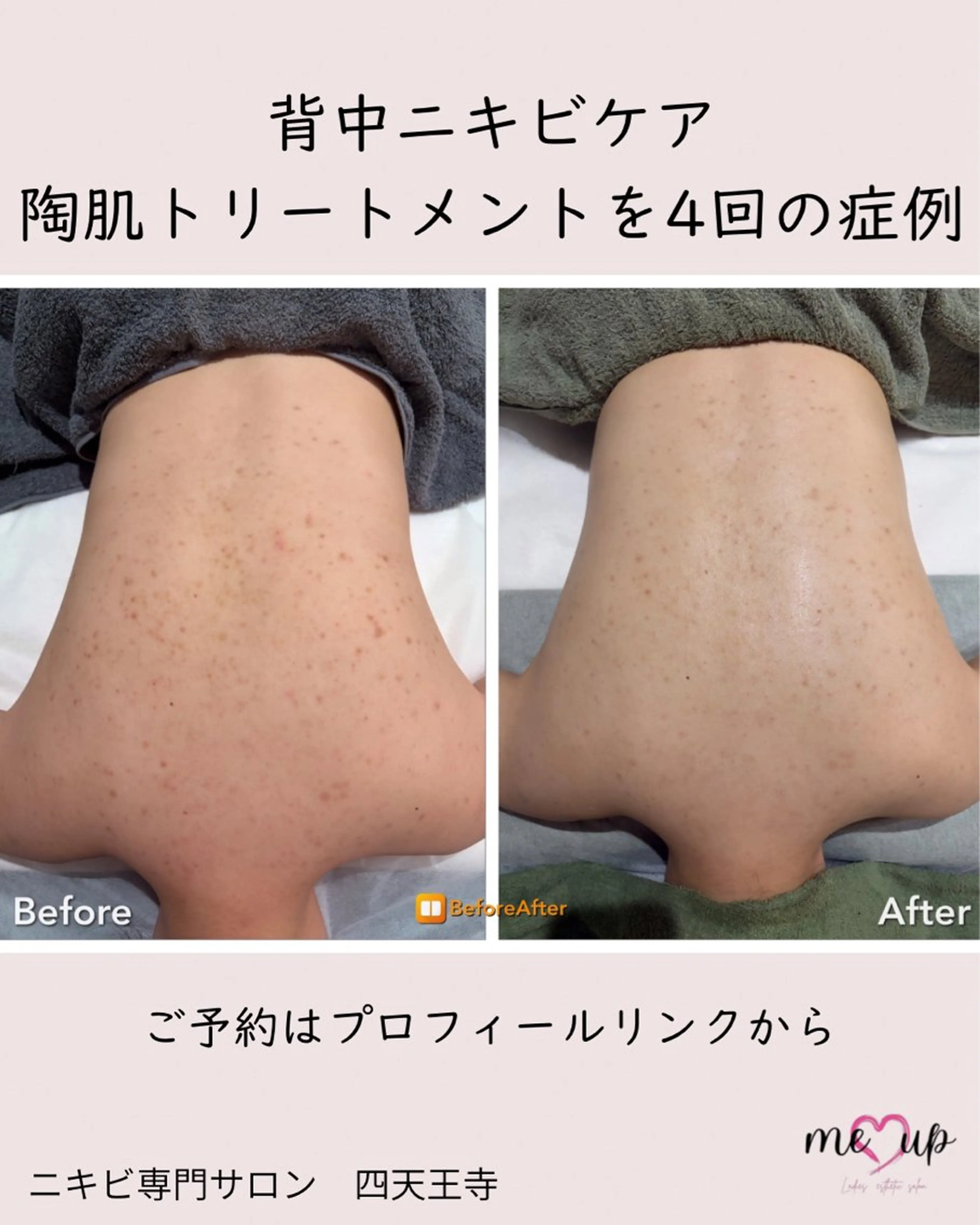 エステ Meupニキビ専門店 背中/ハーブ/肌管理のその他イメージ