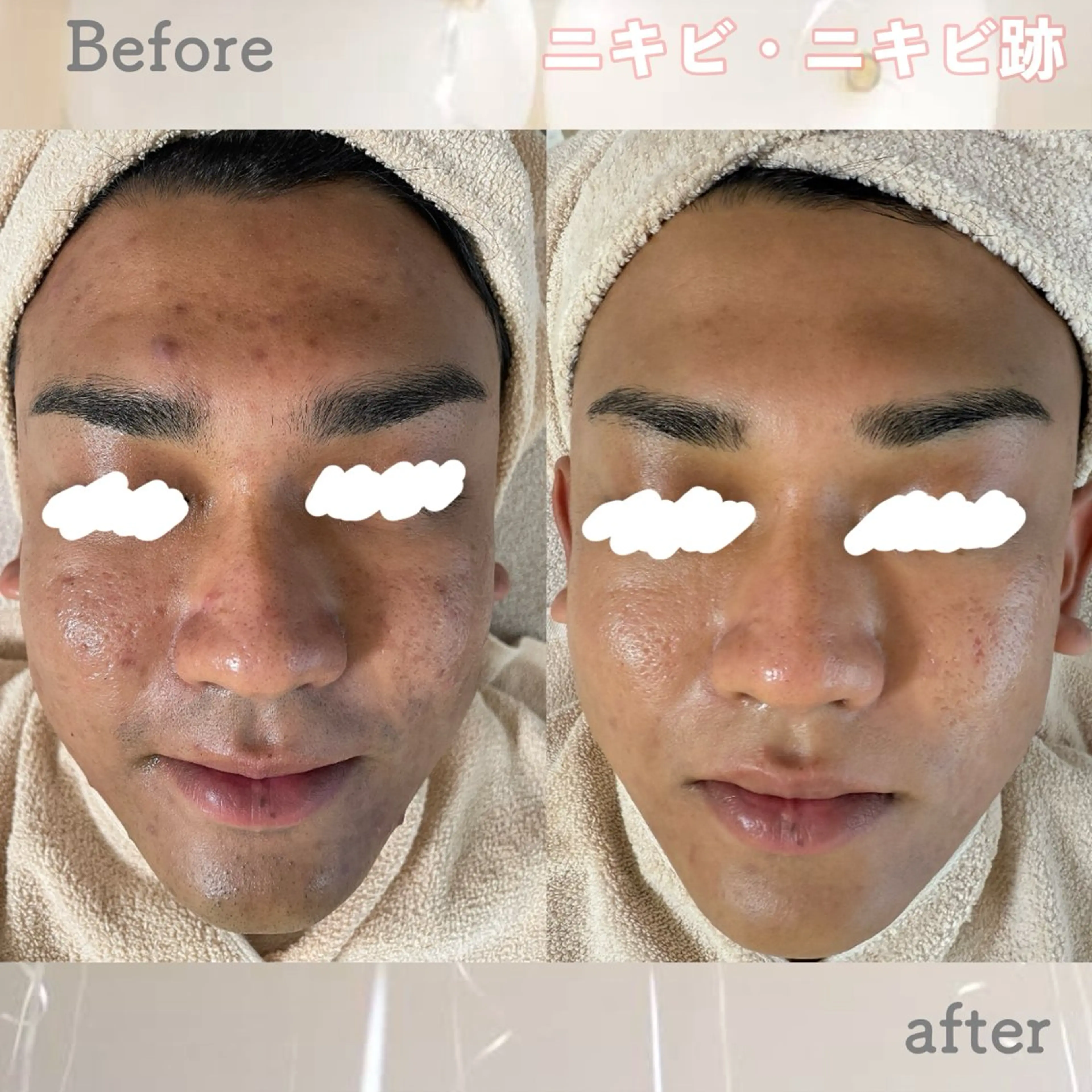 エステ ニキビ&跡改善サロン オーナー光木のエステ・リラクイメージ