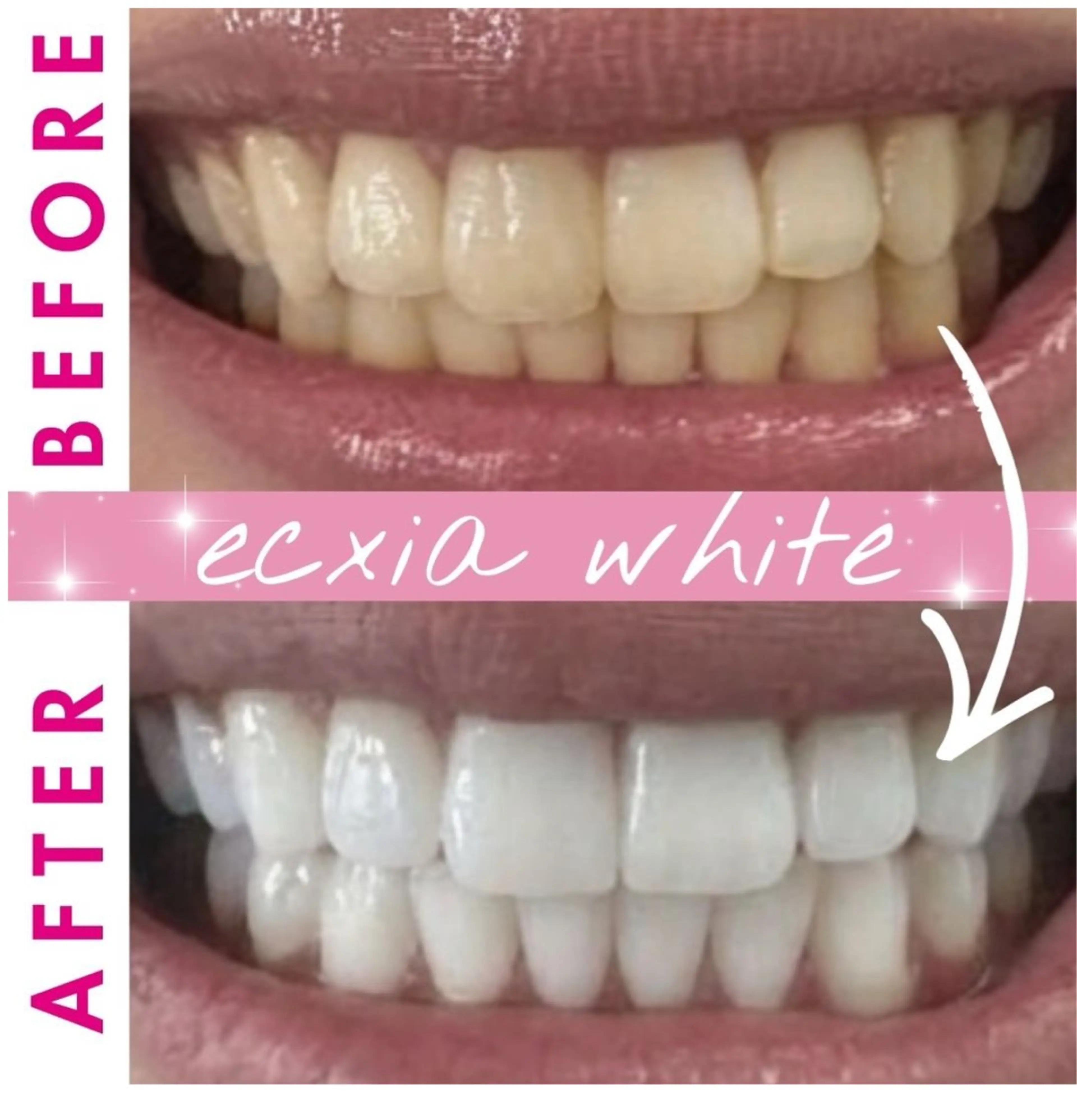 【定額★通い放題】セルフホワイトニング¥11000/円の写真