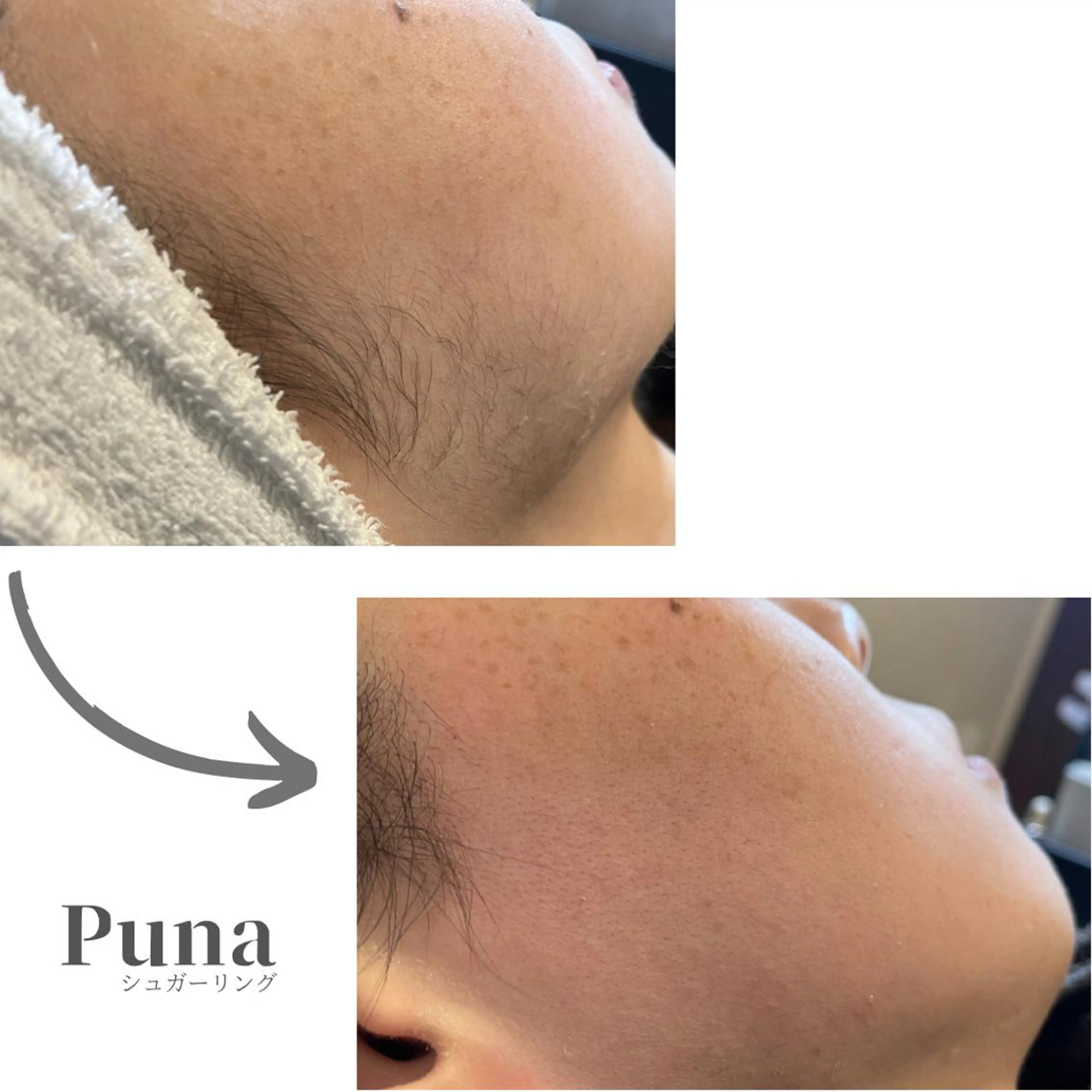 女性【シュガーリング】フェイス脱毛（保湿パック付）全顔の写真