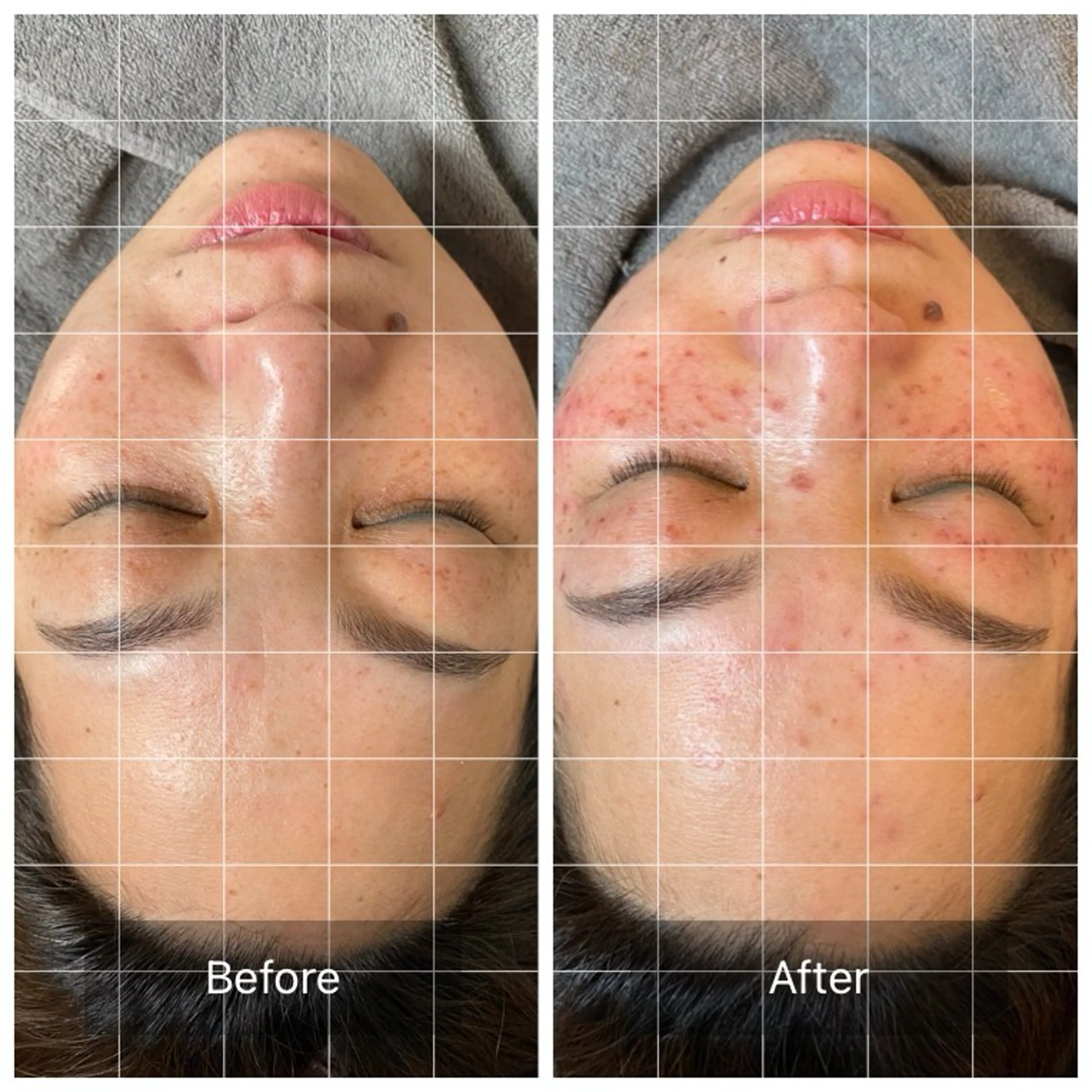 肌改善グリーンピール 東川口/浦和美園のエステ・リラクイメージ