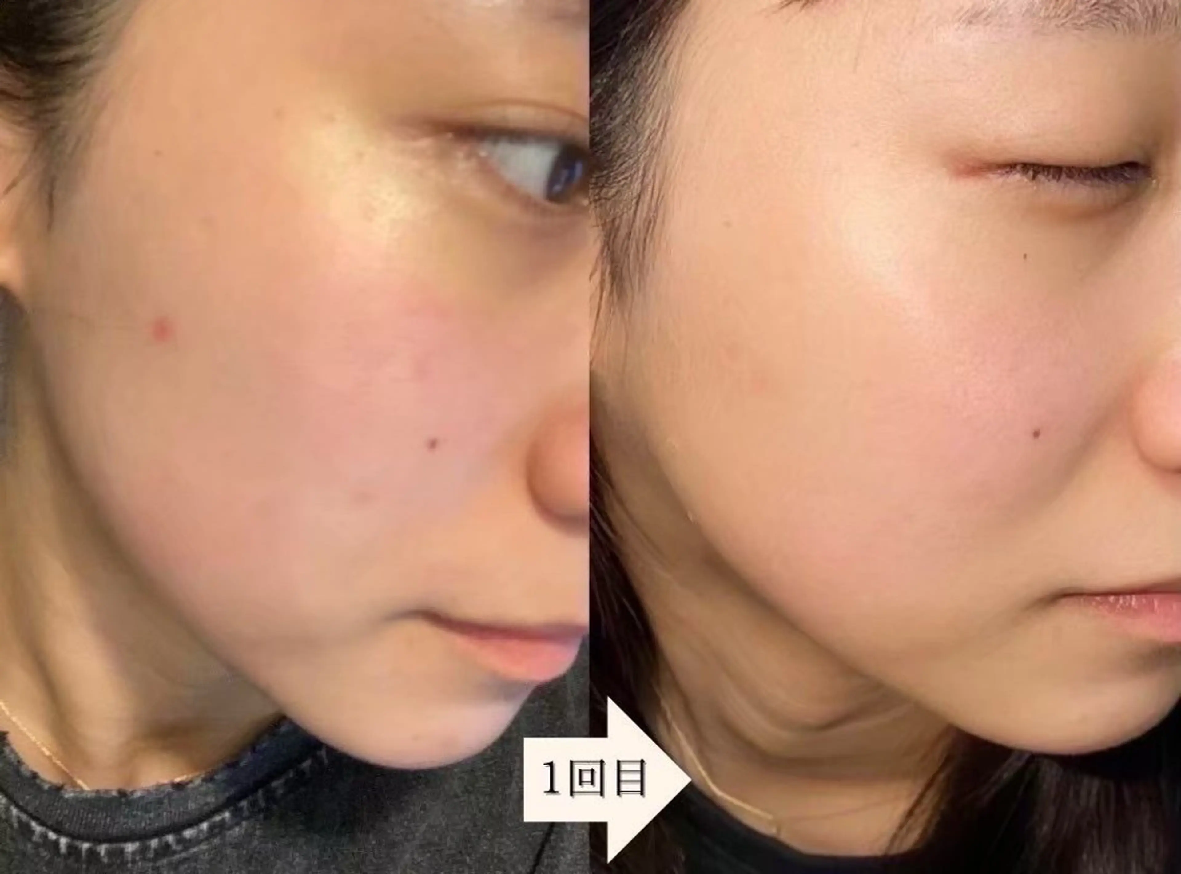 eto.所属・肌質改善サロンeto ニキビ・ニキビ跡のエステ・リラクイメージ