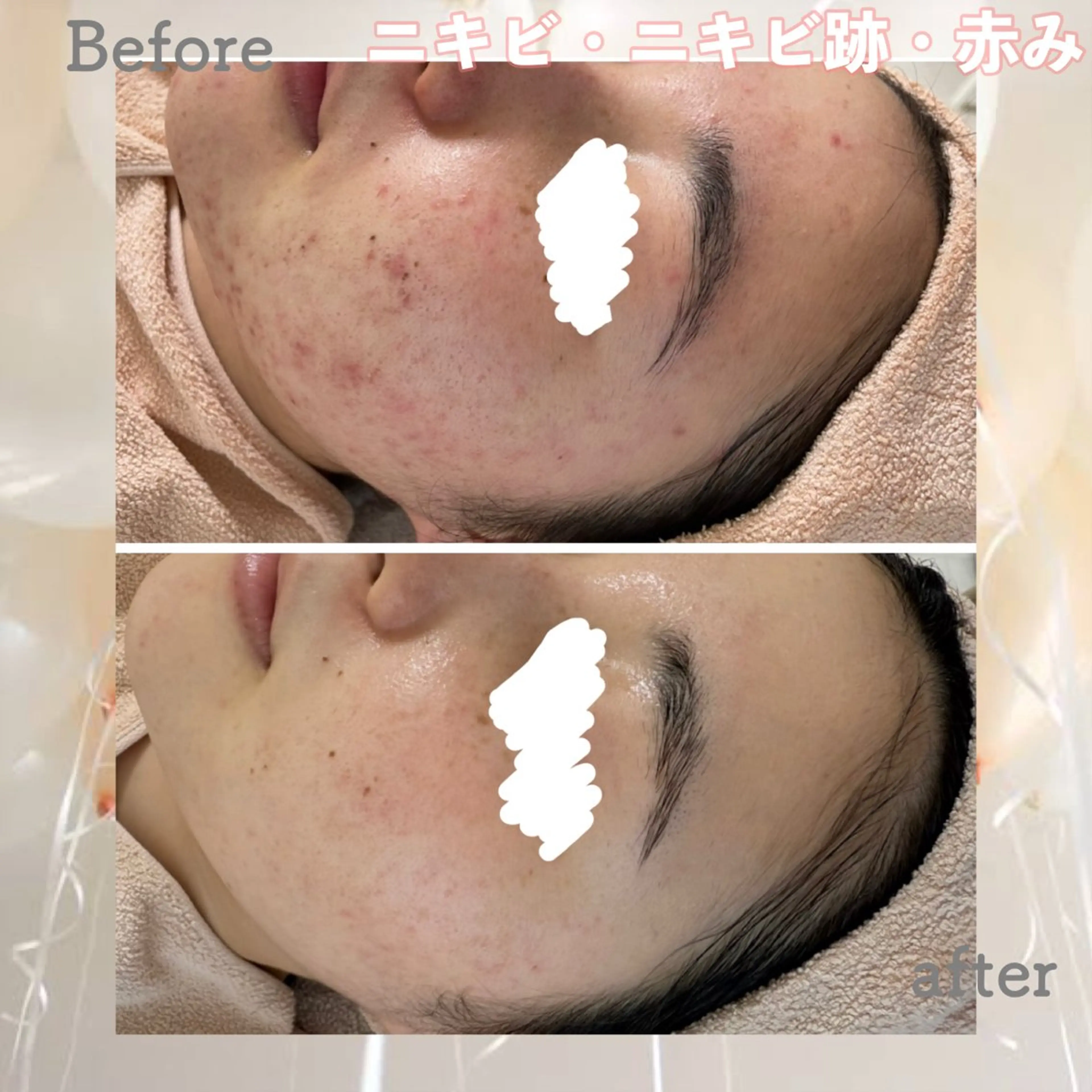 エステ ニキビ&跡改善サロン オーナー光木のエステ・リラクイメージ