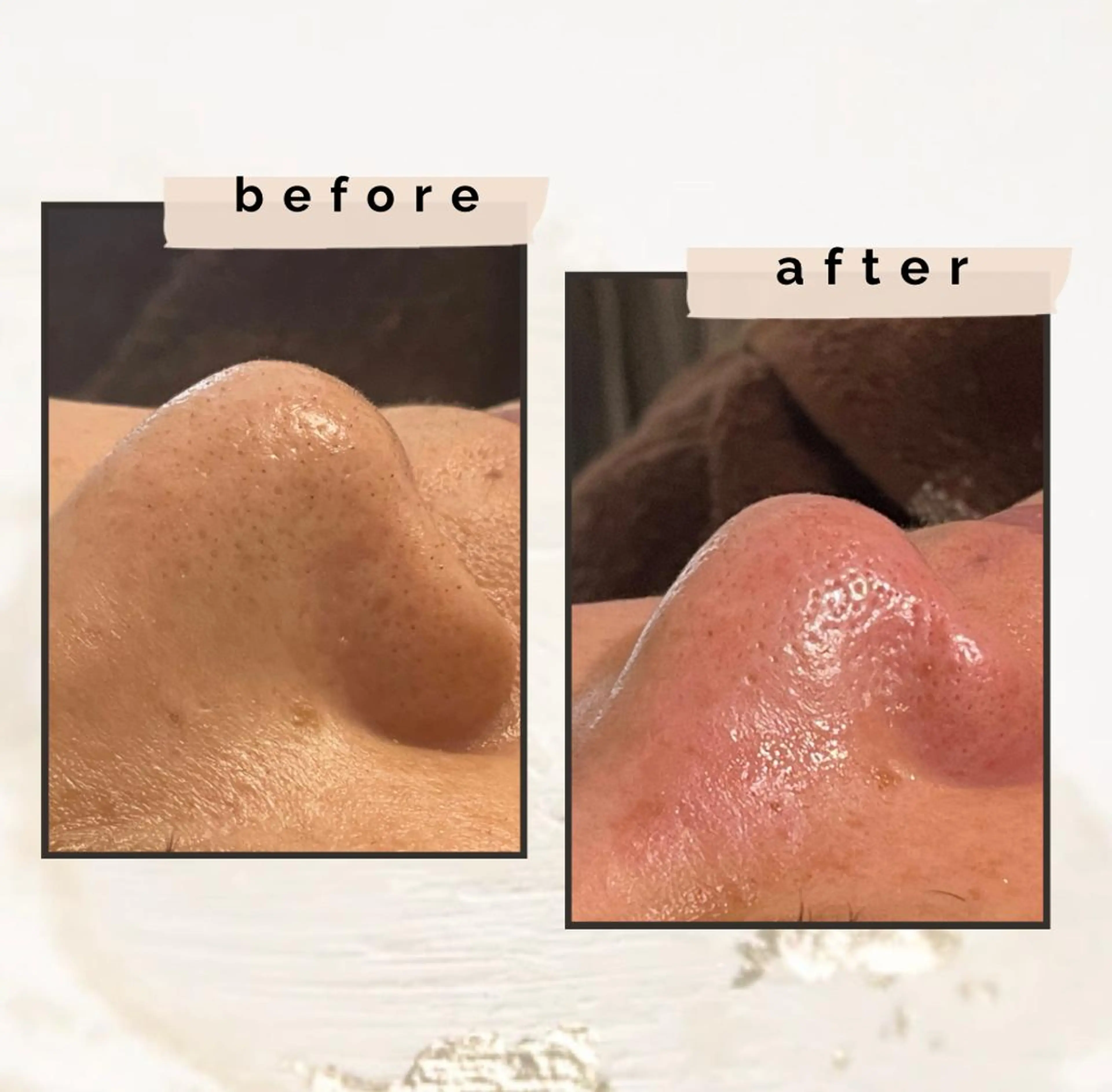 毛穴改善👃🏼ハイドラフェイシャル✨毛穴洗浄でざらついた肌や黒ずみを除去🫧清潔感UP🩷LEDドーム付き💡の写真