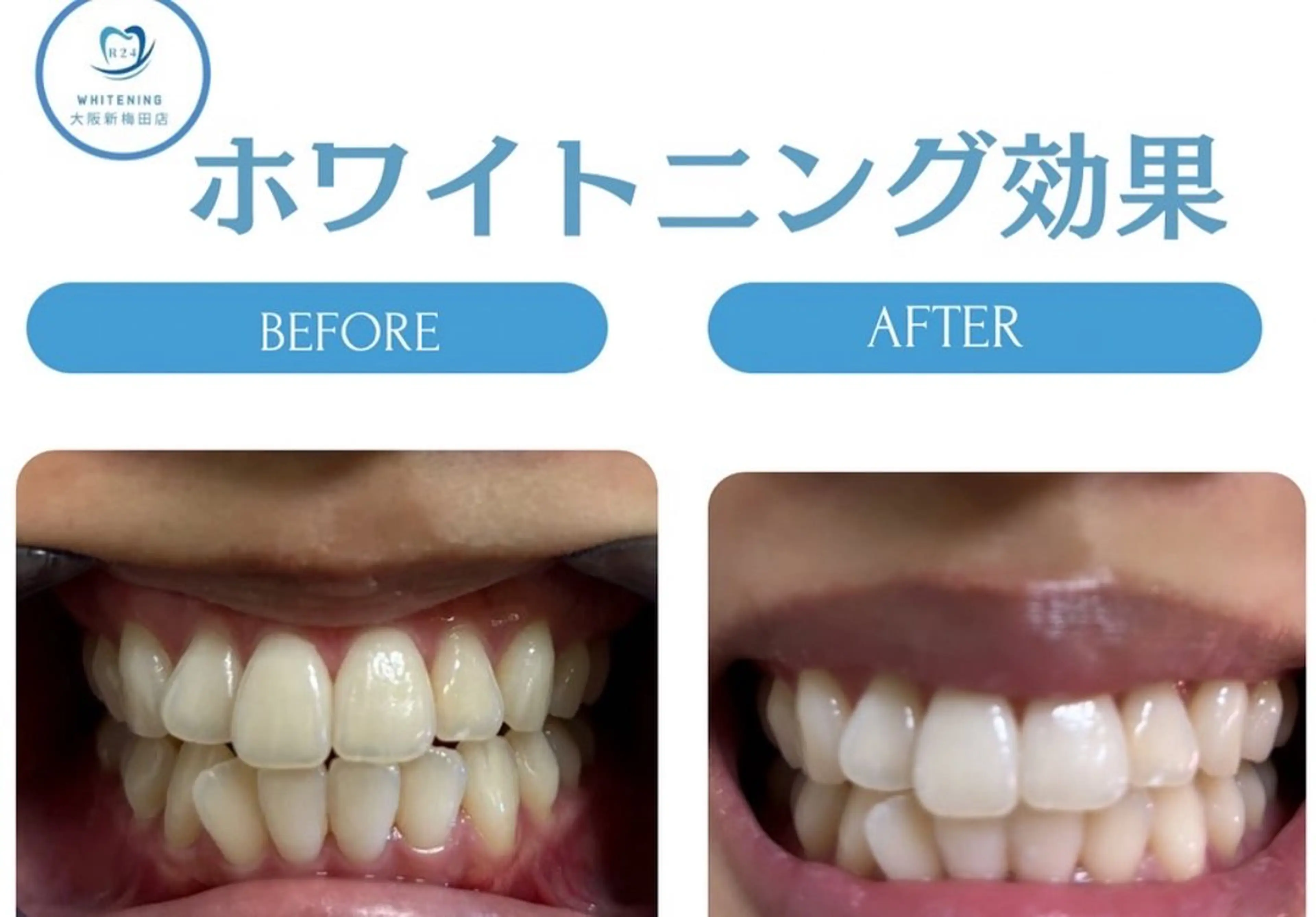 セルフホワイトニング20分初回体験（大阪梅田地域最安値）の写真