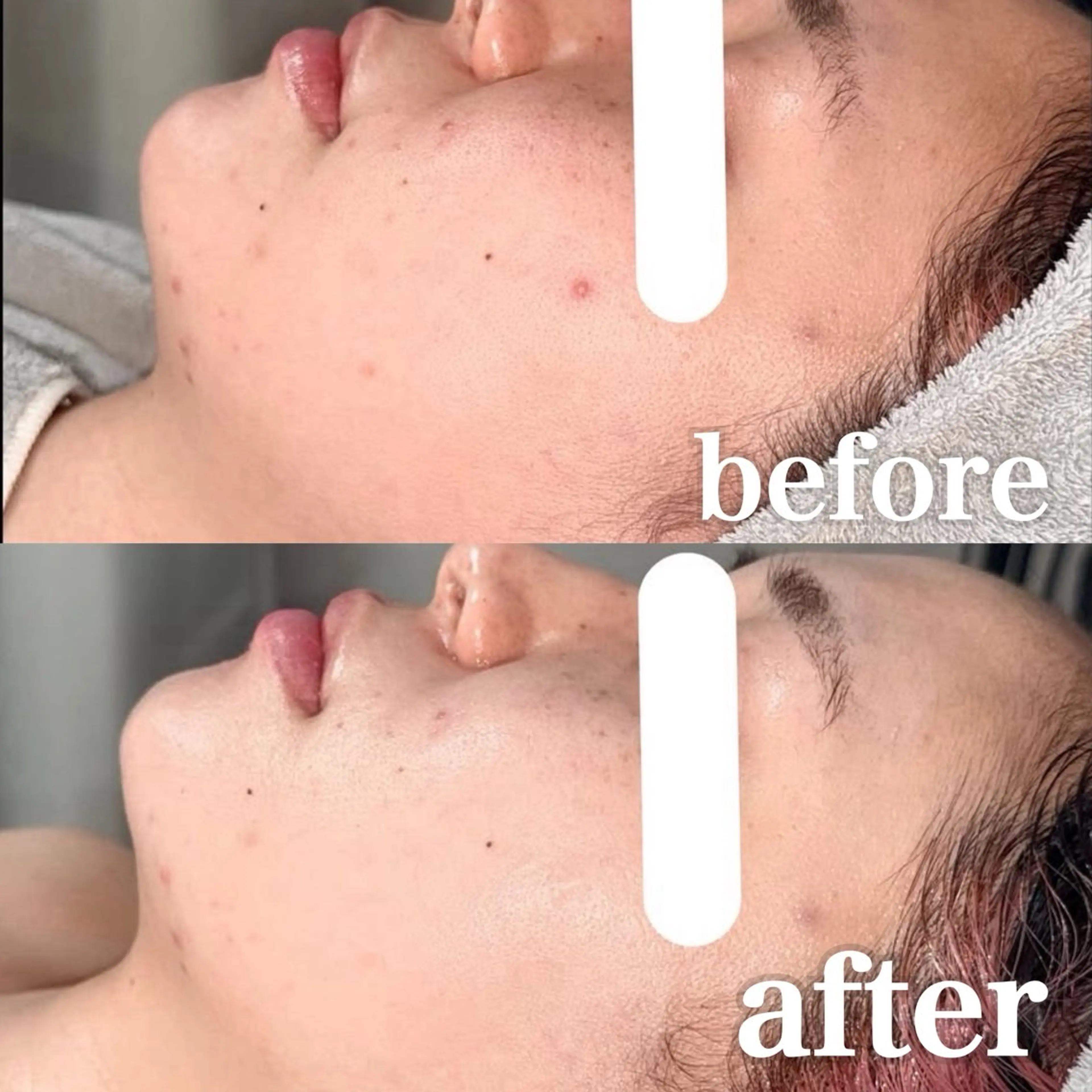 【2名限定】剥離なし国産ハーブピーリング+幹細胞ペプチド・ペップビューエレポ導入でしっかり毛穴レス✨️の写真