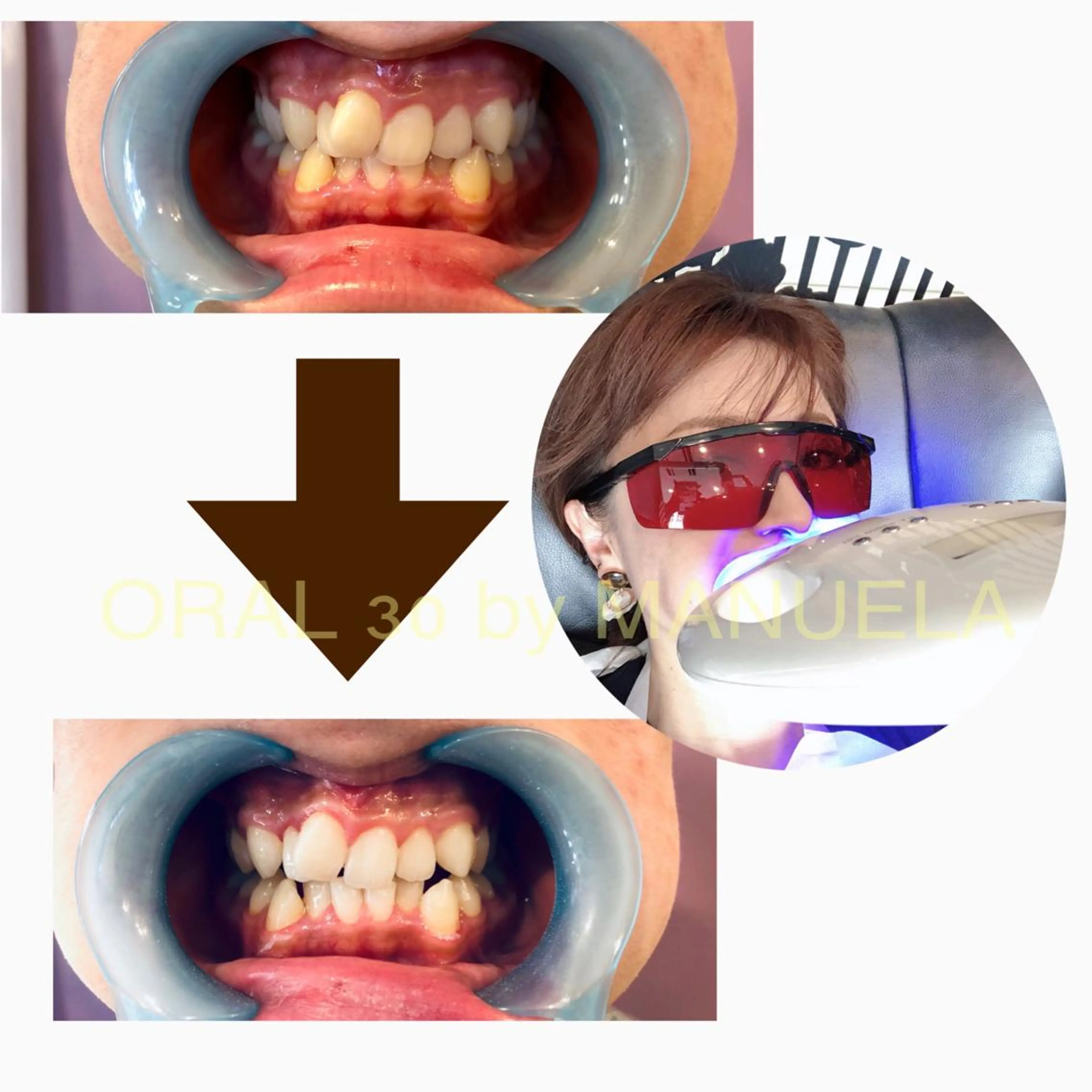 初めてのセルフホワイトニングの写真