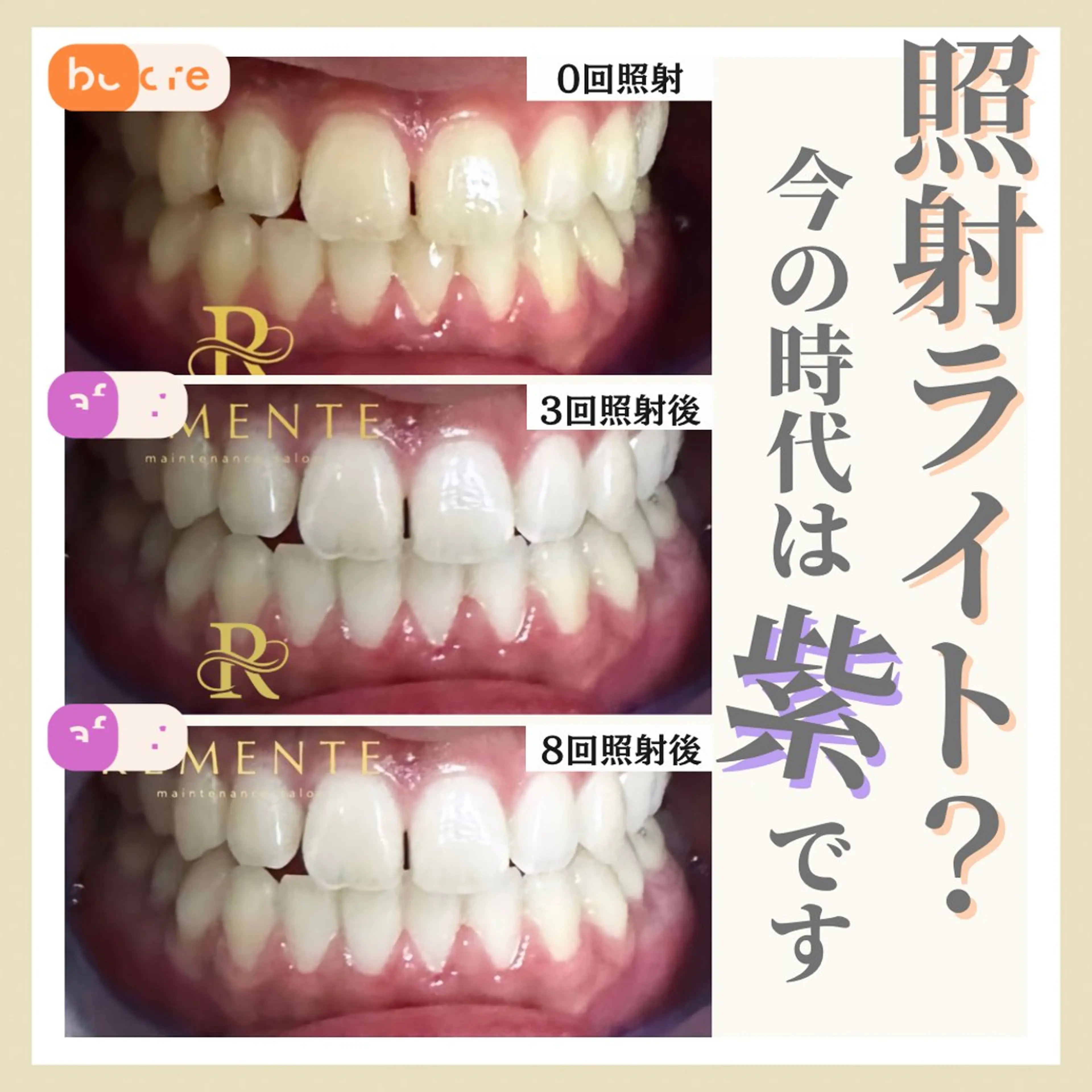 ⭐️平日限定⭐️セルフホワイトニング◆照射MAX10分×2セット分以上20分照射🔥✨◆ ¥20,000→¥2,000の写真