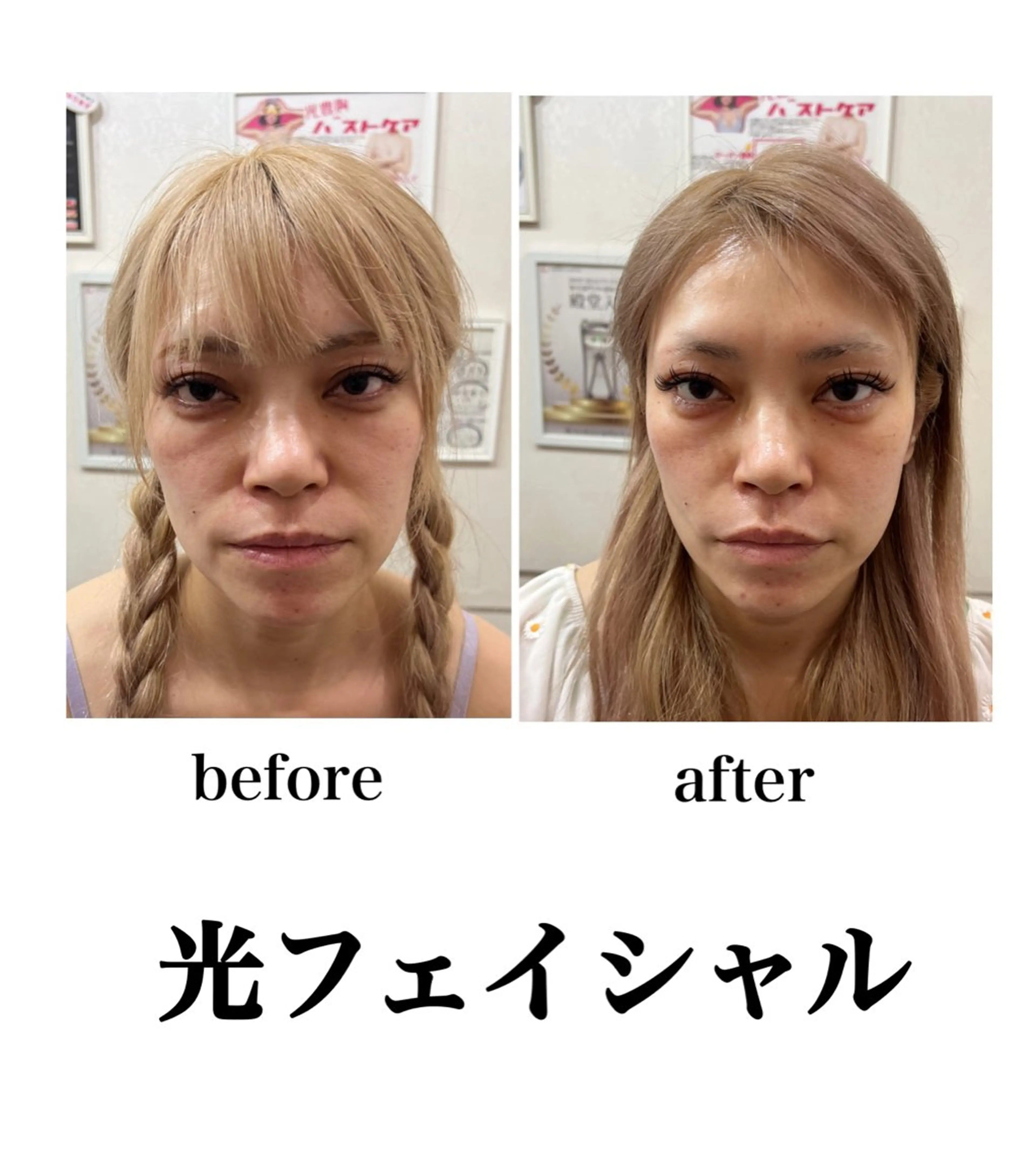 毛穴改善/脱毛 ネイル　川上久仁子のエステ・リラクイメージ