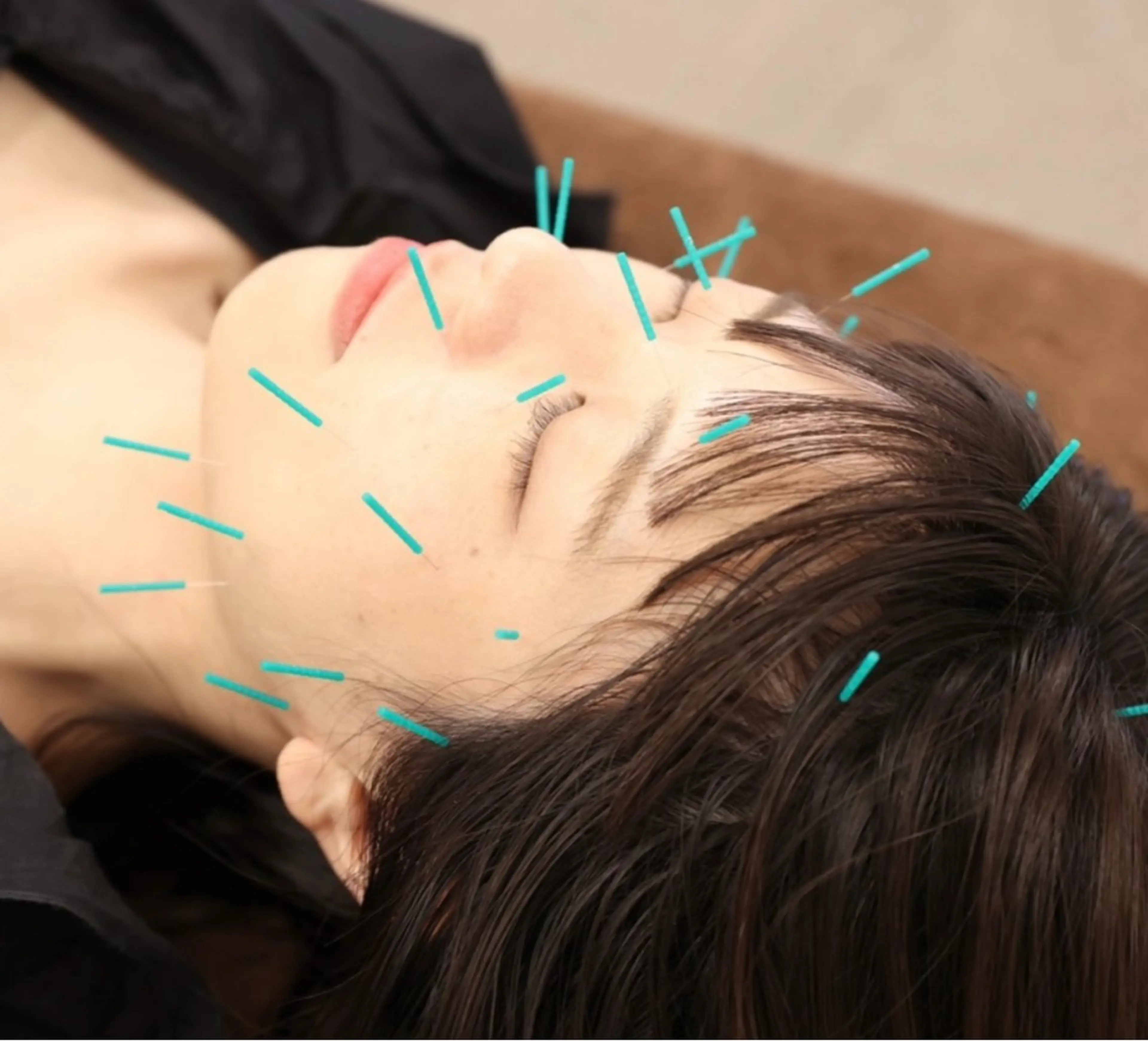 美容鍼＋首こり肩こり整体＋姿勢矯正（施術後口コミ必須）の写真