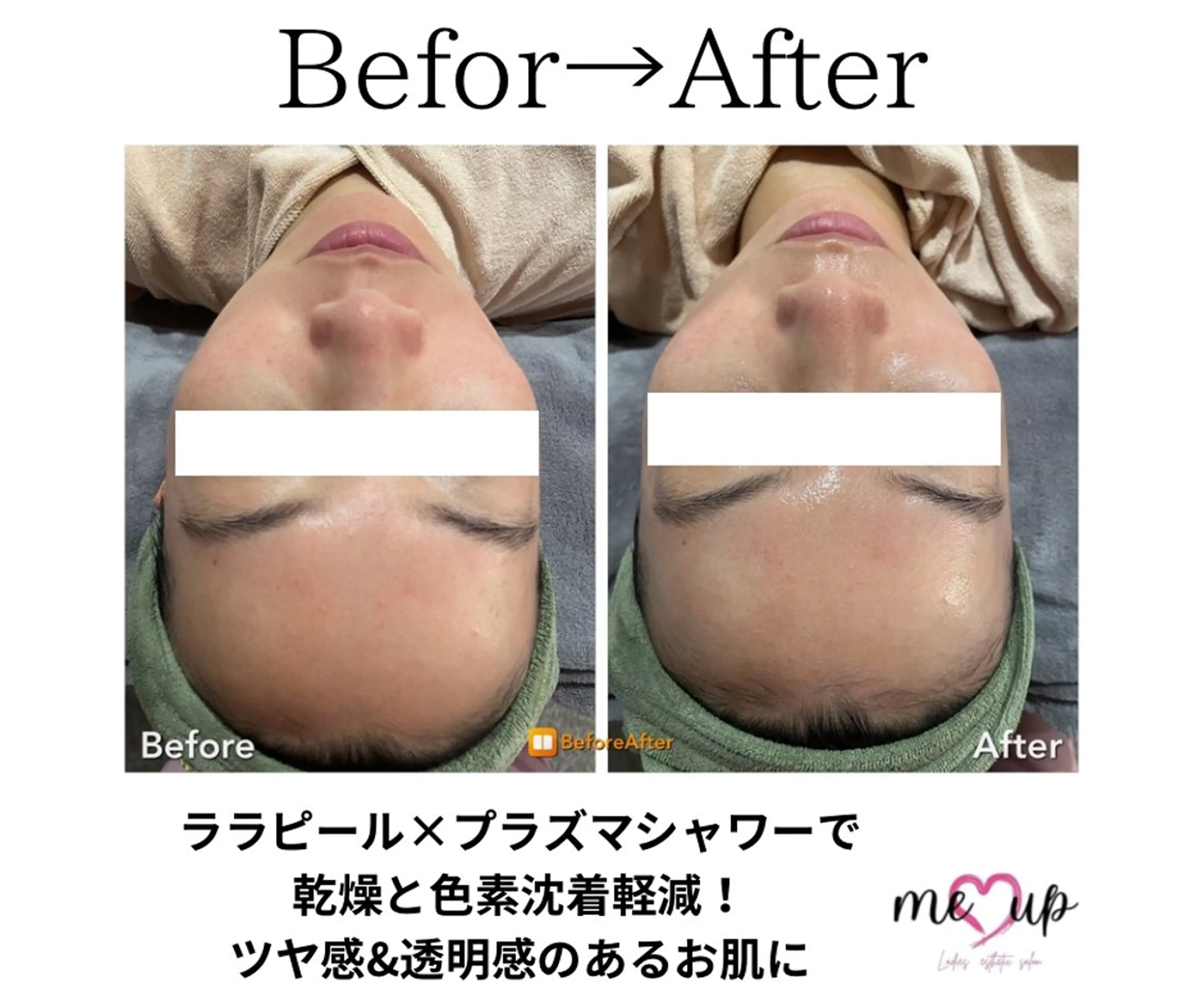 エステ Meupニキビ専門店 背中/ハーブ/肌管理のその他イメージ