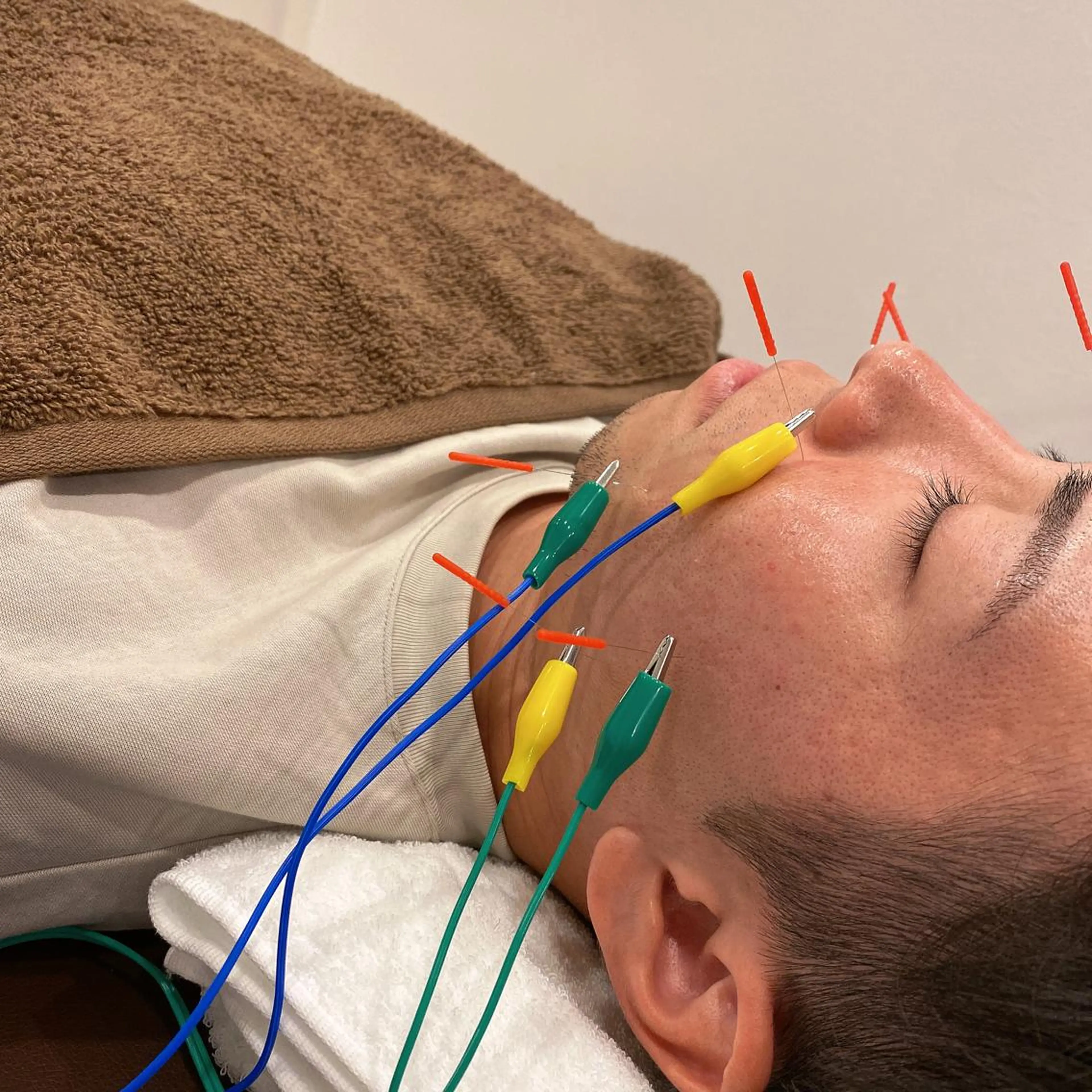 エステ リラク 美容鍼灸Solana所属・肌質改善×美容鍼 ゆいのエステ・リラクイメージ