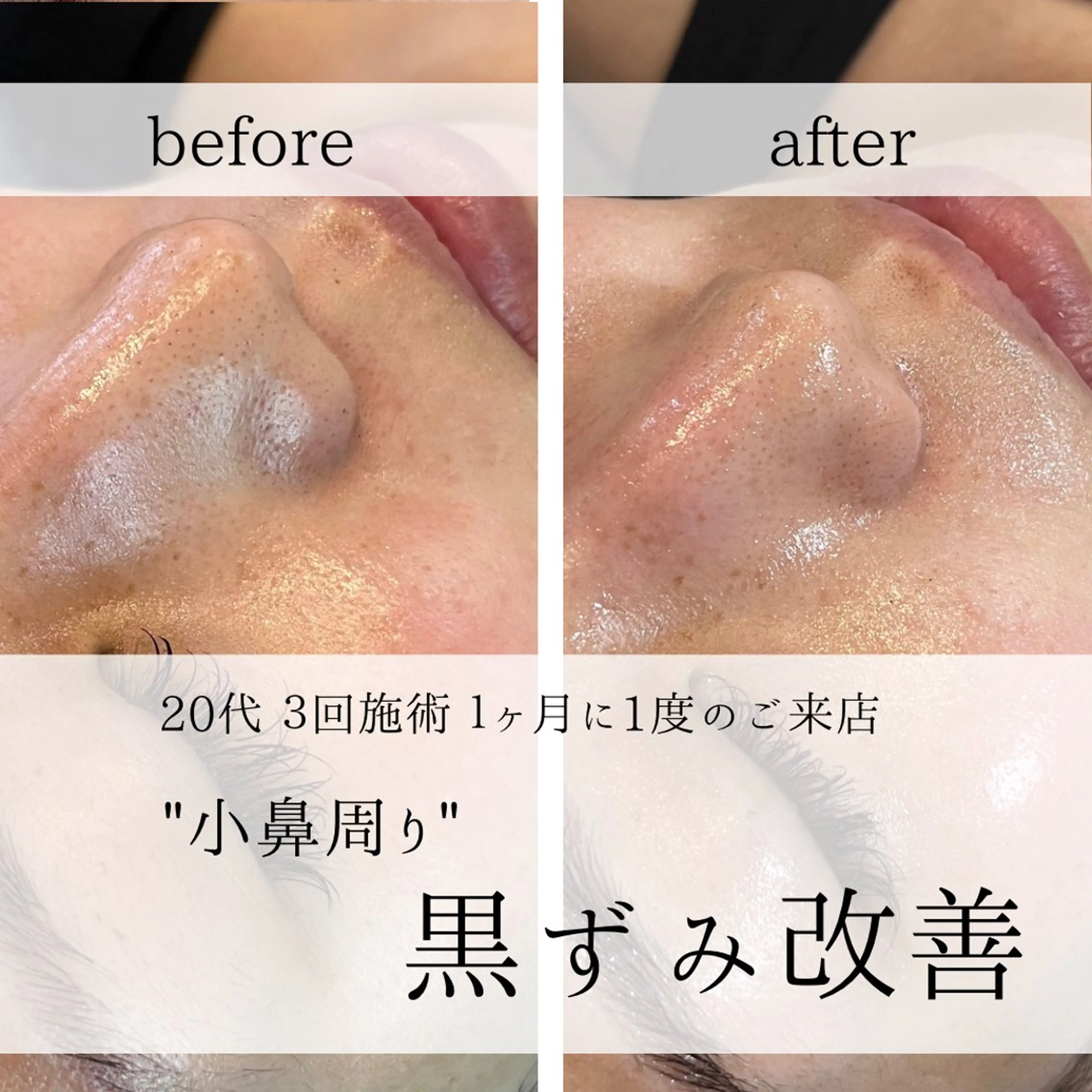 yc.hacci 【ハーブピーリング】のエステ・リラクイメージ