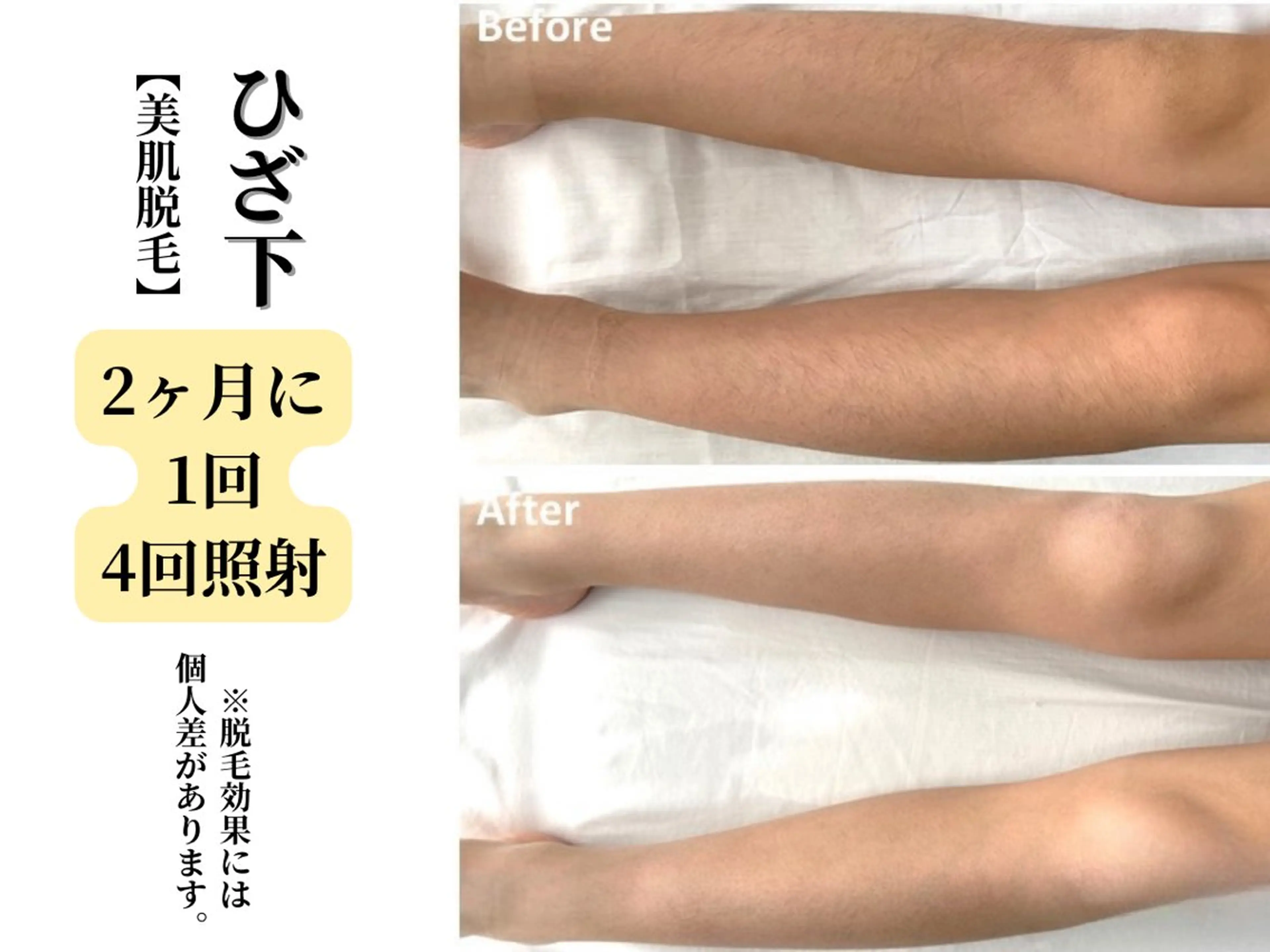 脱毛 Belle White所属・本格痩身＊肌質改善＊ BelleWhiteのエステ・リラクイメージ