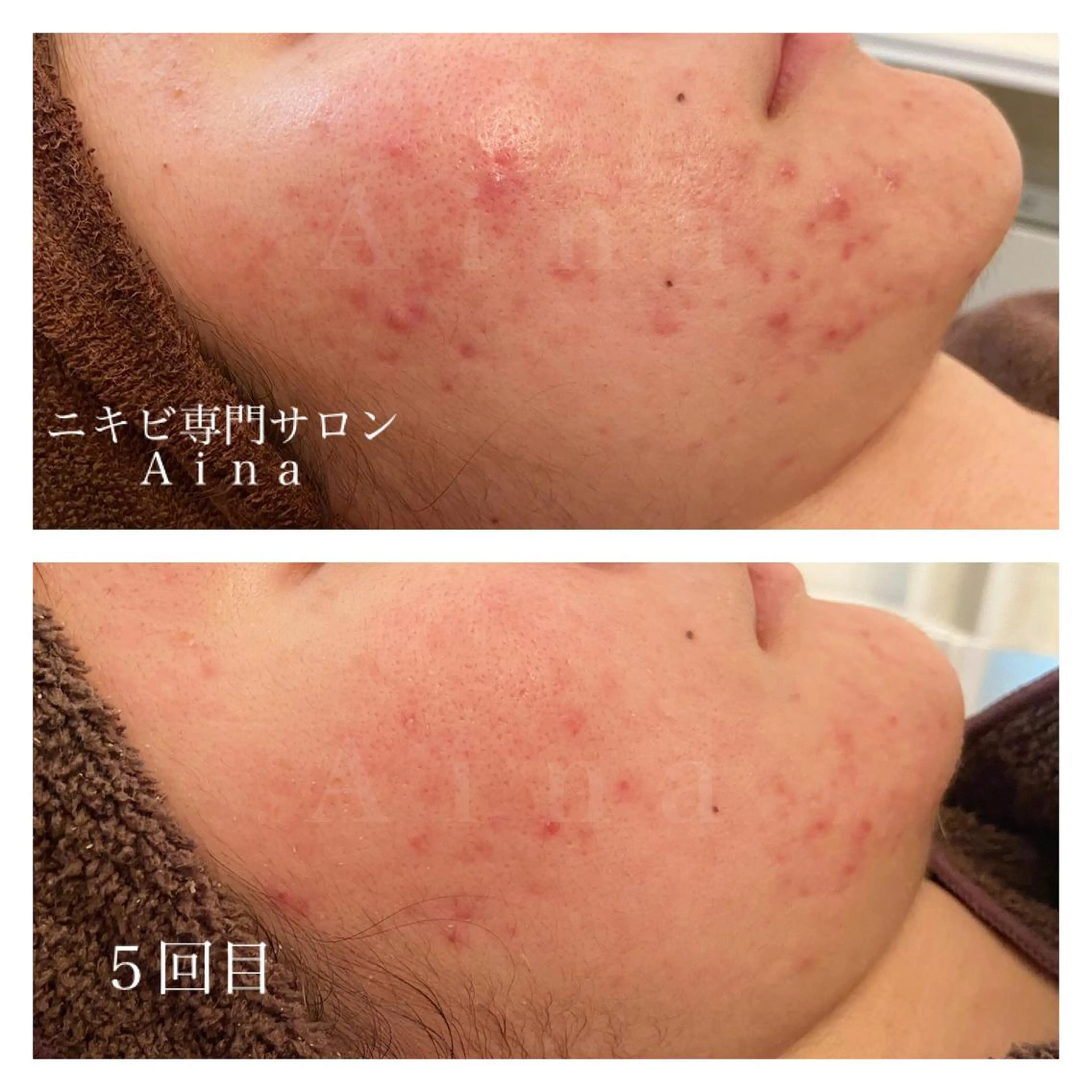 セミロング カラー パーマ ヘアアレンジ メンズ キッズ ネイル マツエク・マツパ ニキビ跡専門サロン Ainaのエステ・リラクイメージ