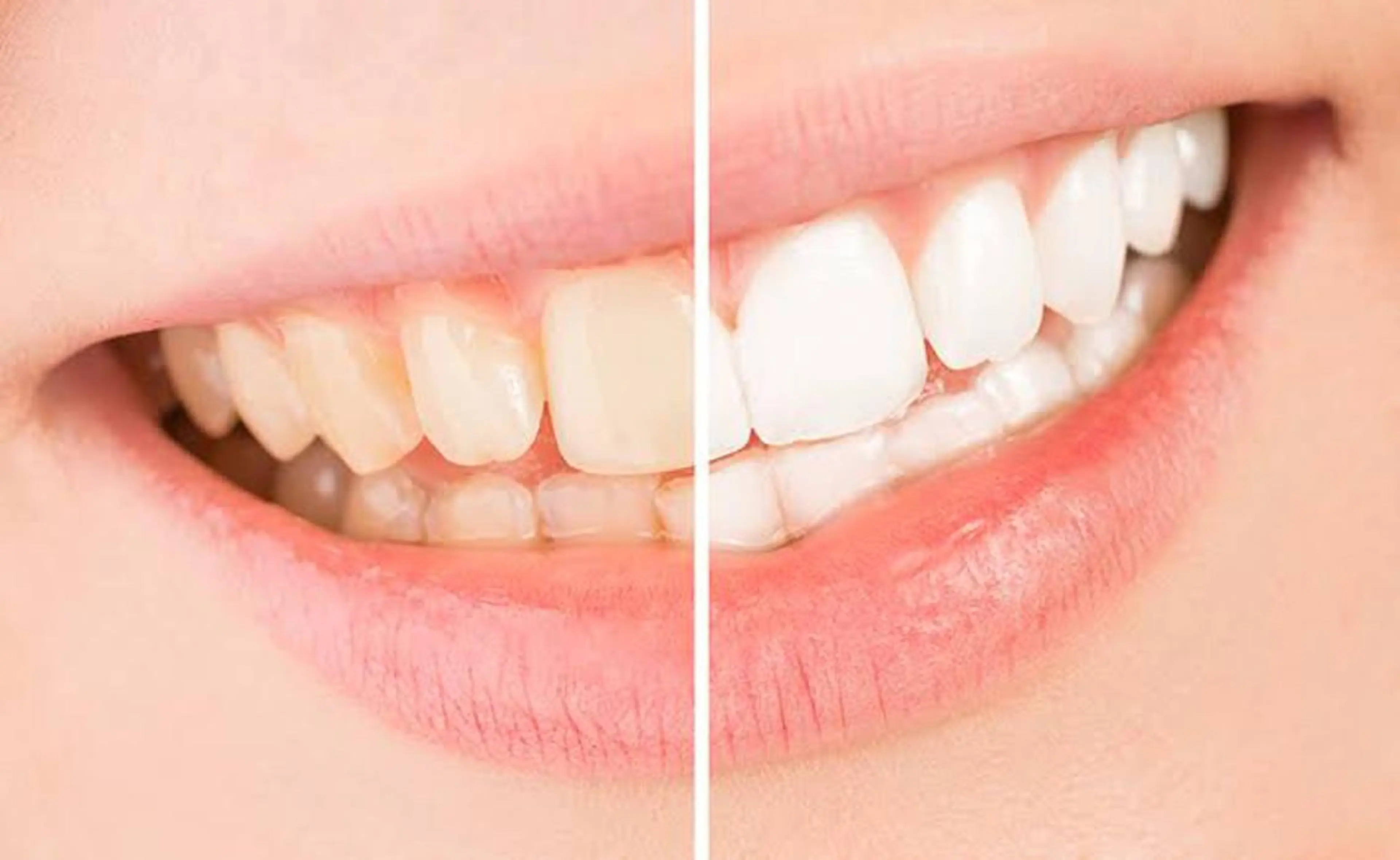 その他 脱毛専門サロンELIXIR（ｴﾘｸｻｰ）所属・脱毛&ホワイトニング ELIXIR×ULTのエステ・リラクイメージ