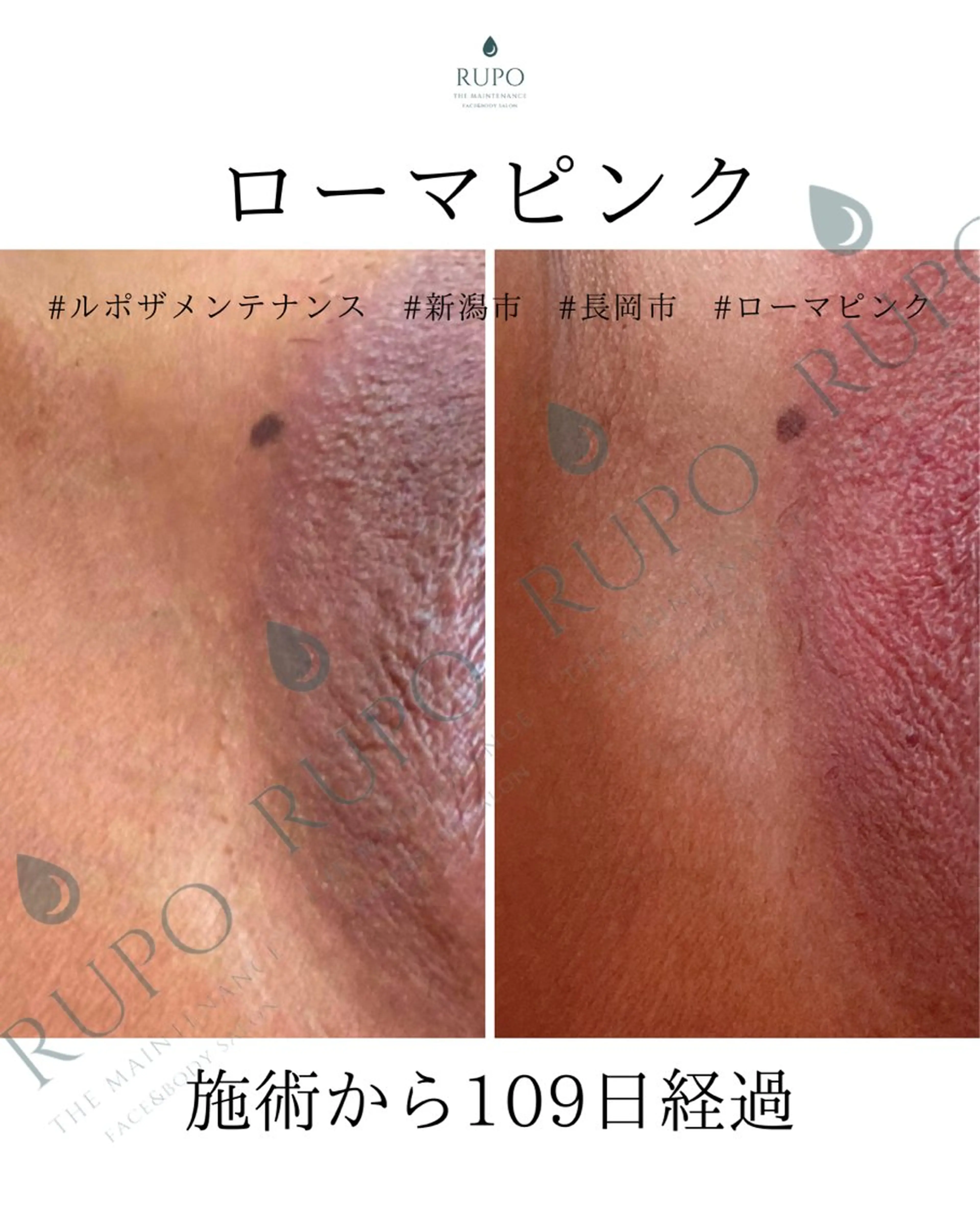 【VかI ローマピンク】カウンセリング無料＆当日施術可/通常314600/モニター191400の写真