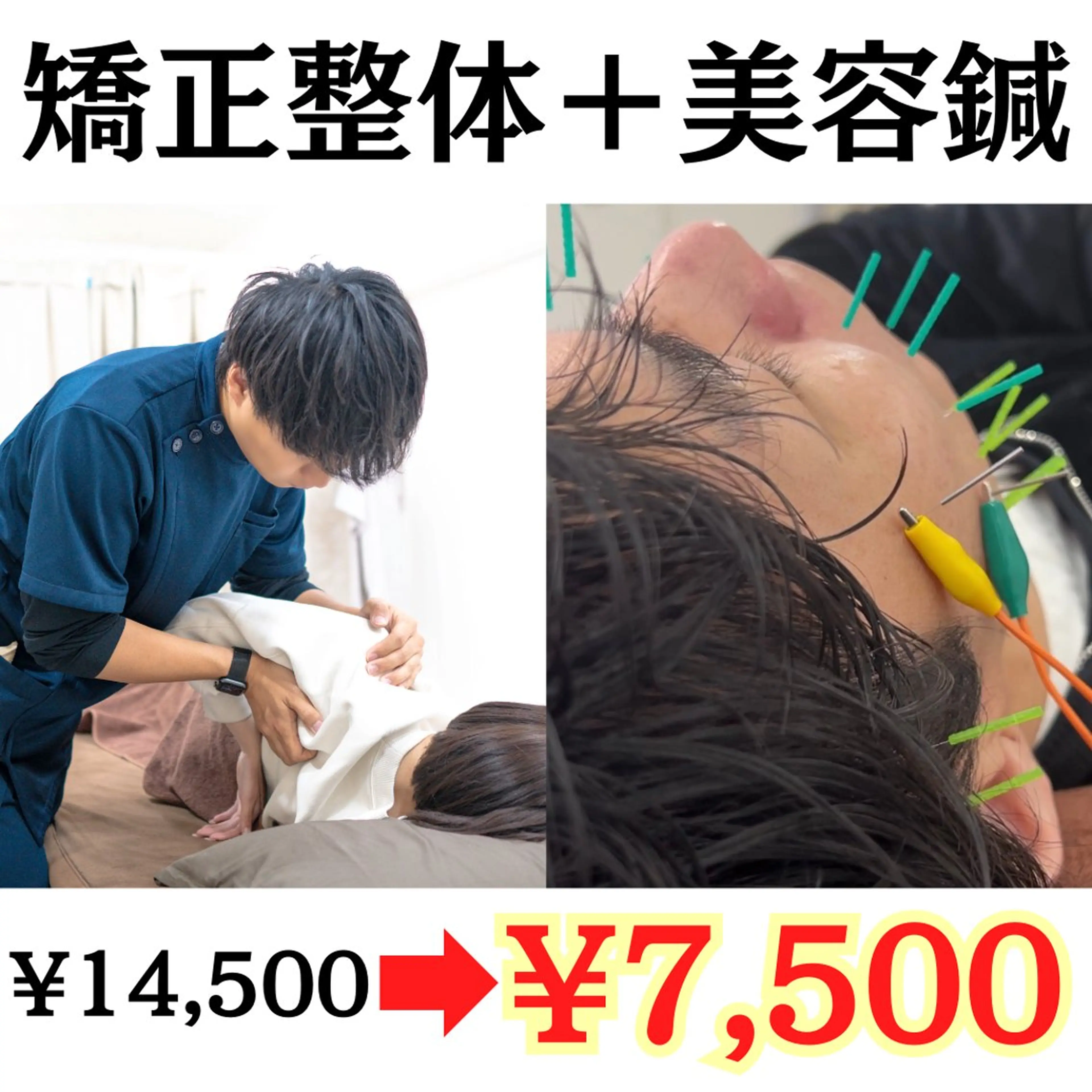 【✨ミニモSALE✨】矯正整体＋美容鍼（80分）(猫背/肩こり/腰痛/小顔/リフトアップ/シワ/たるみ)の写真