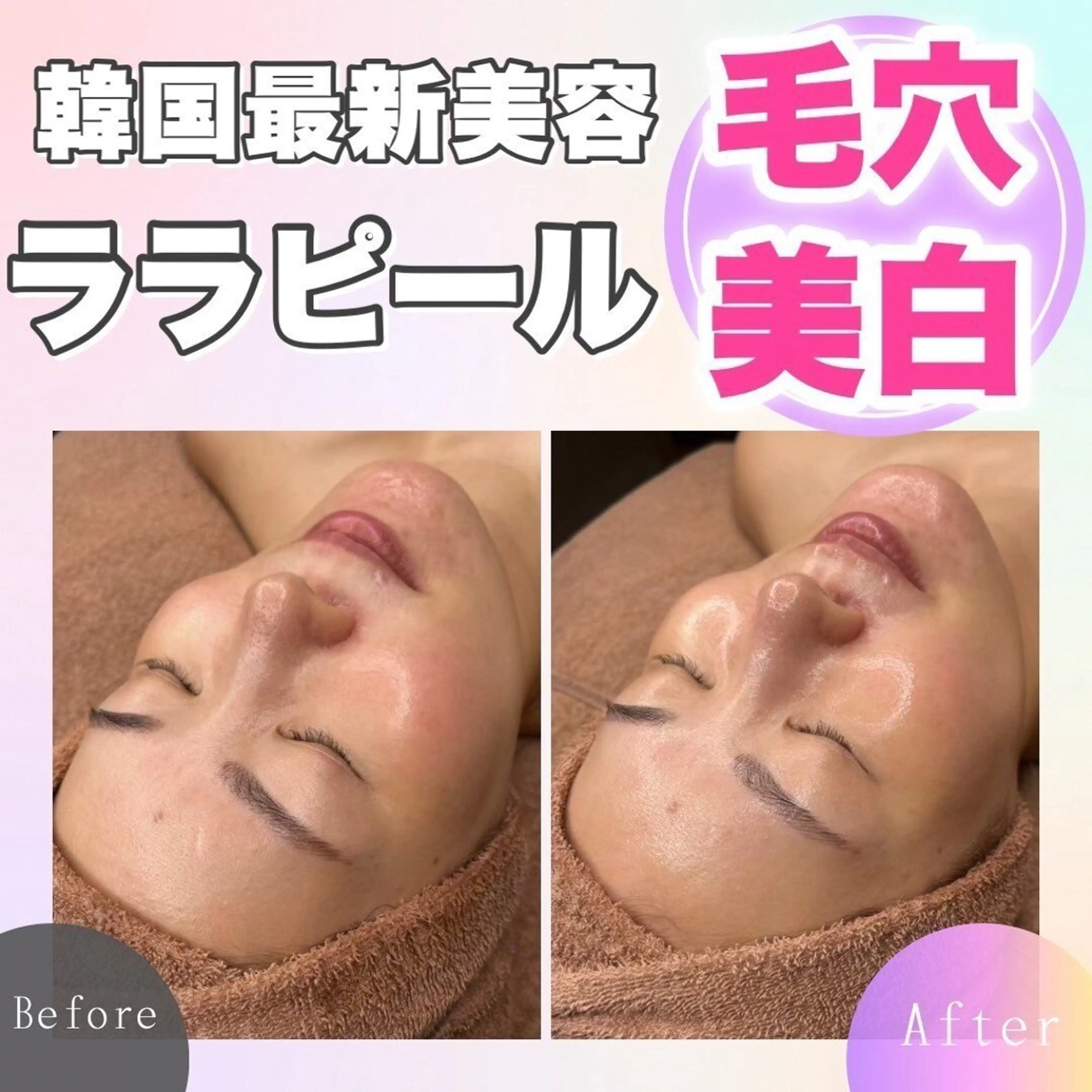 💫2回目以降のお客様💫 毛穴撲滅！小顔・美白効果◎韓国最新美容🇰🇷ララピール🫧¥16,000の写真