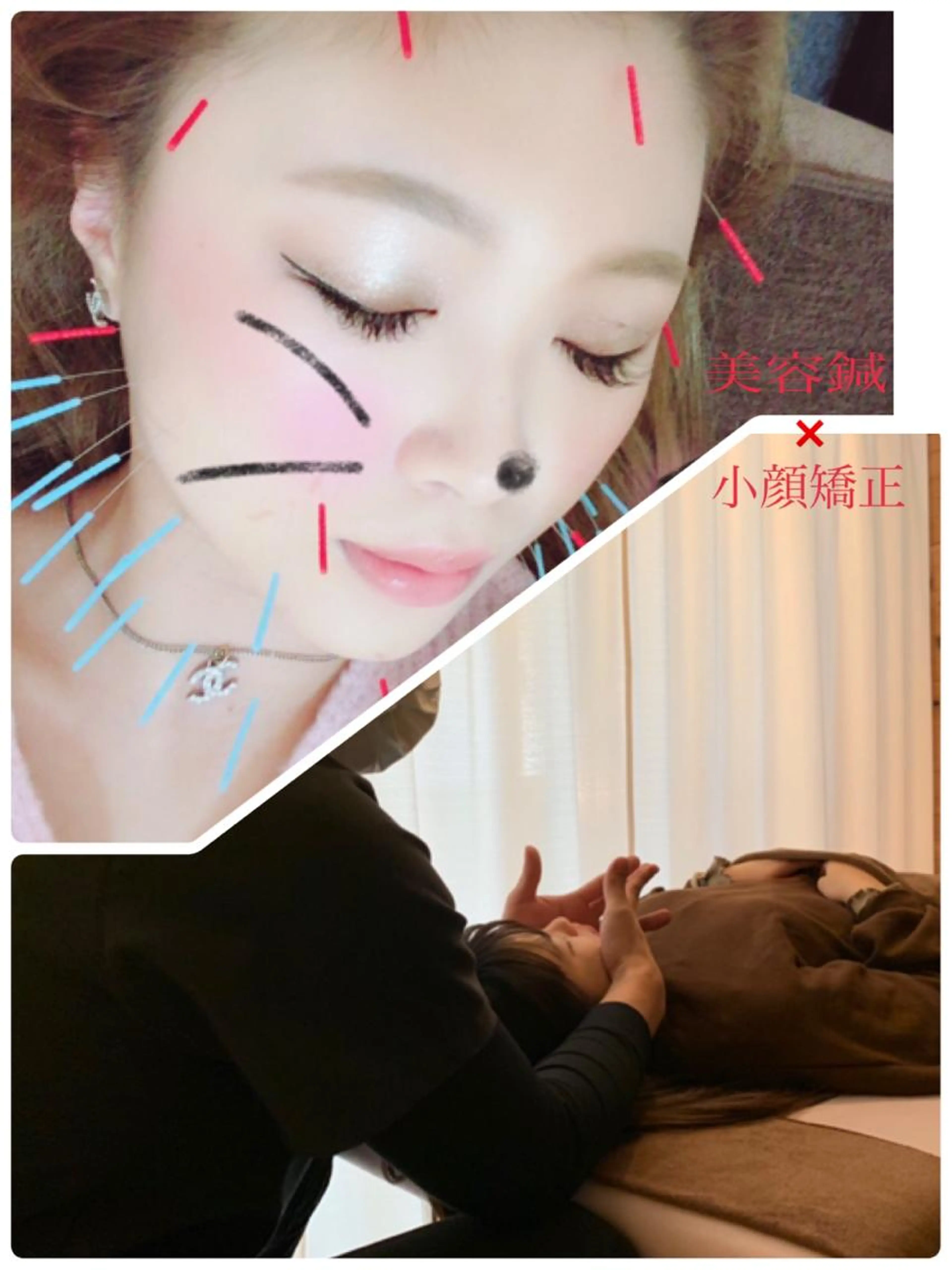 美容鍼＋小顔矯正の写真