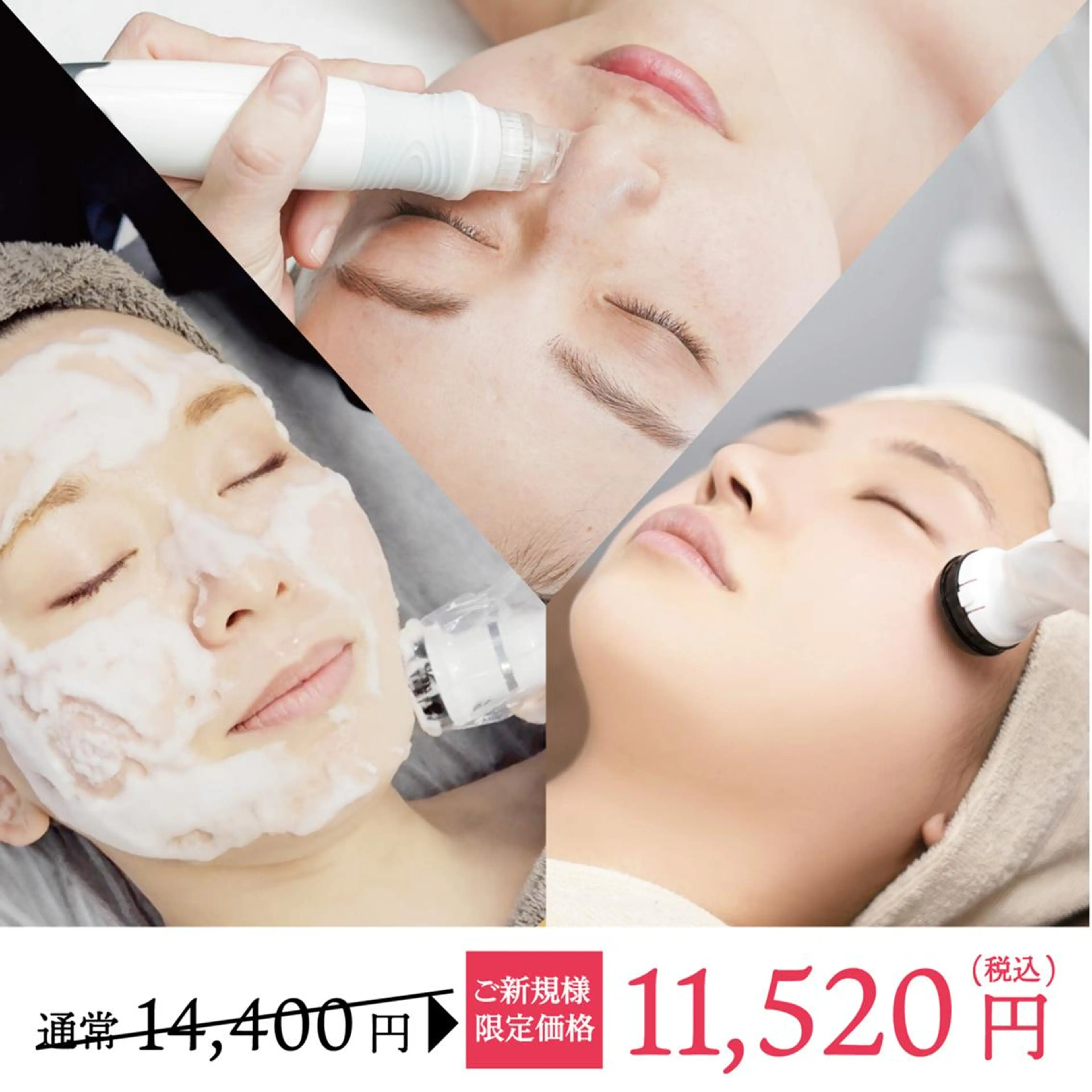 今話題の❣️プラズマにハイドラセットで黒ずみ毛穴開き解消✨炭酸パック＆ヒアルロン酸付の写真