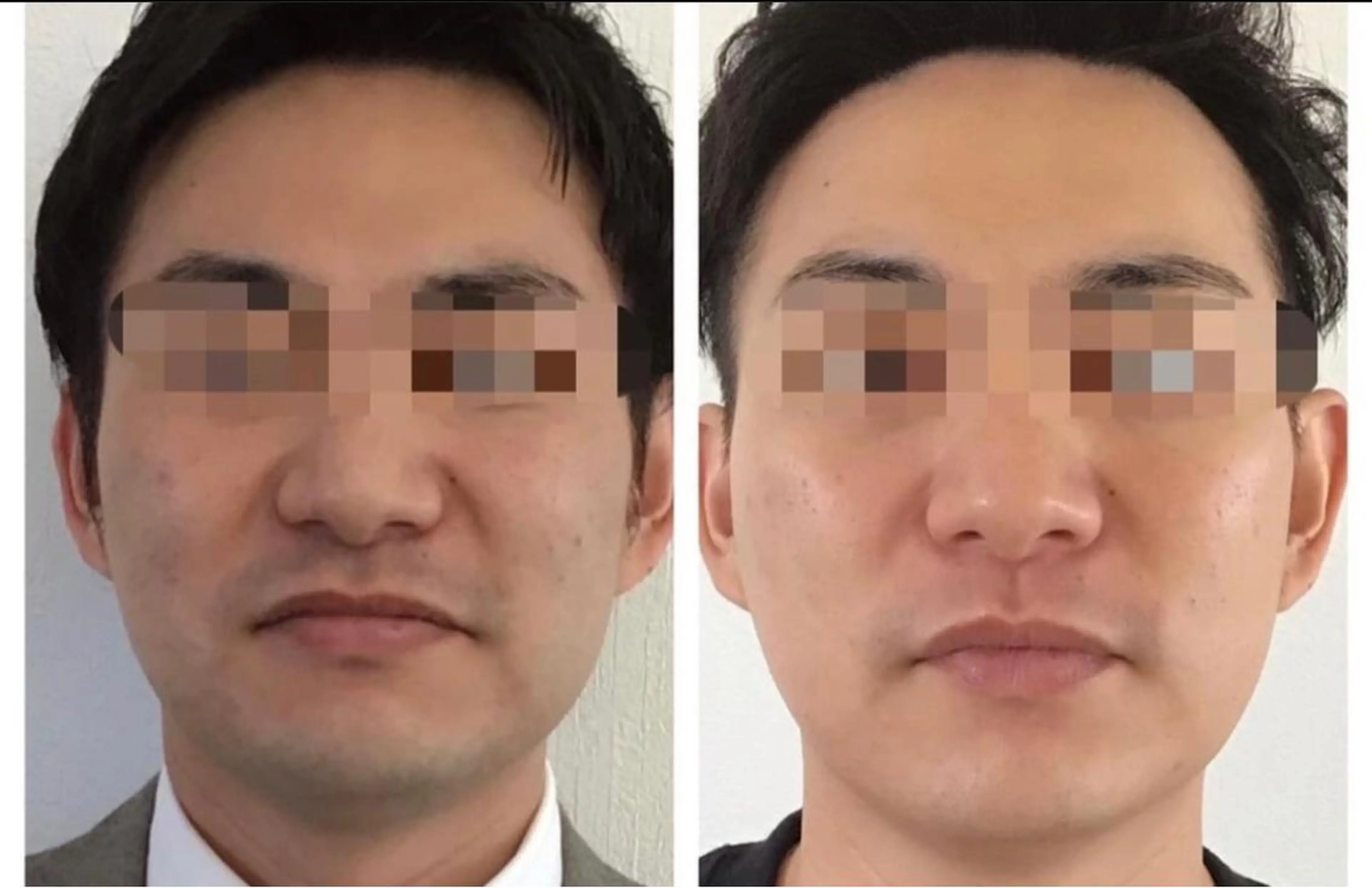 メンズ  〈美肌脱毛〉【 ヒゲ 顔全体】最新マシンで早い卒業 痛くない ひげ脱毛 初回来店or会員の写真