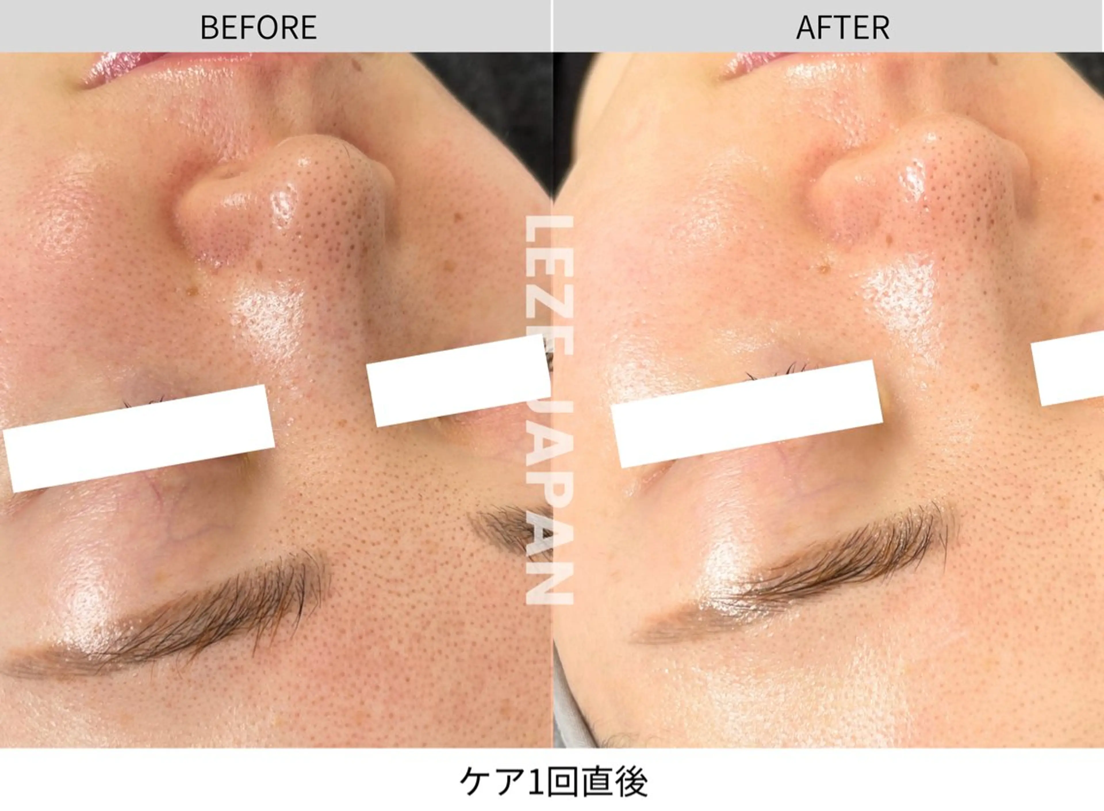 韓国肌管理🇰🇷ダーマハイドロセラピーの写真