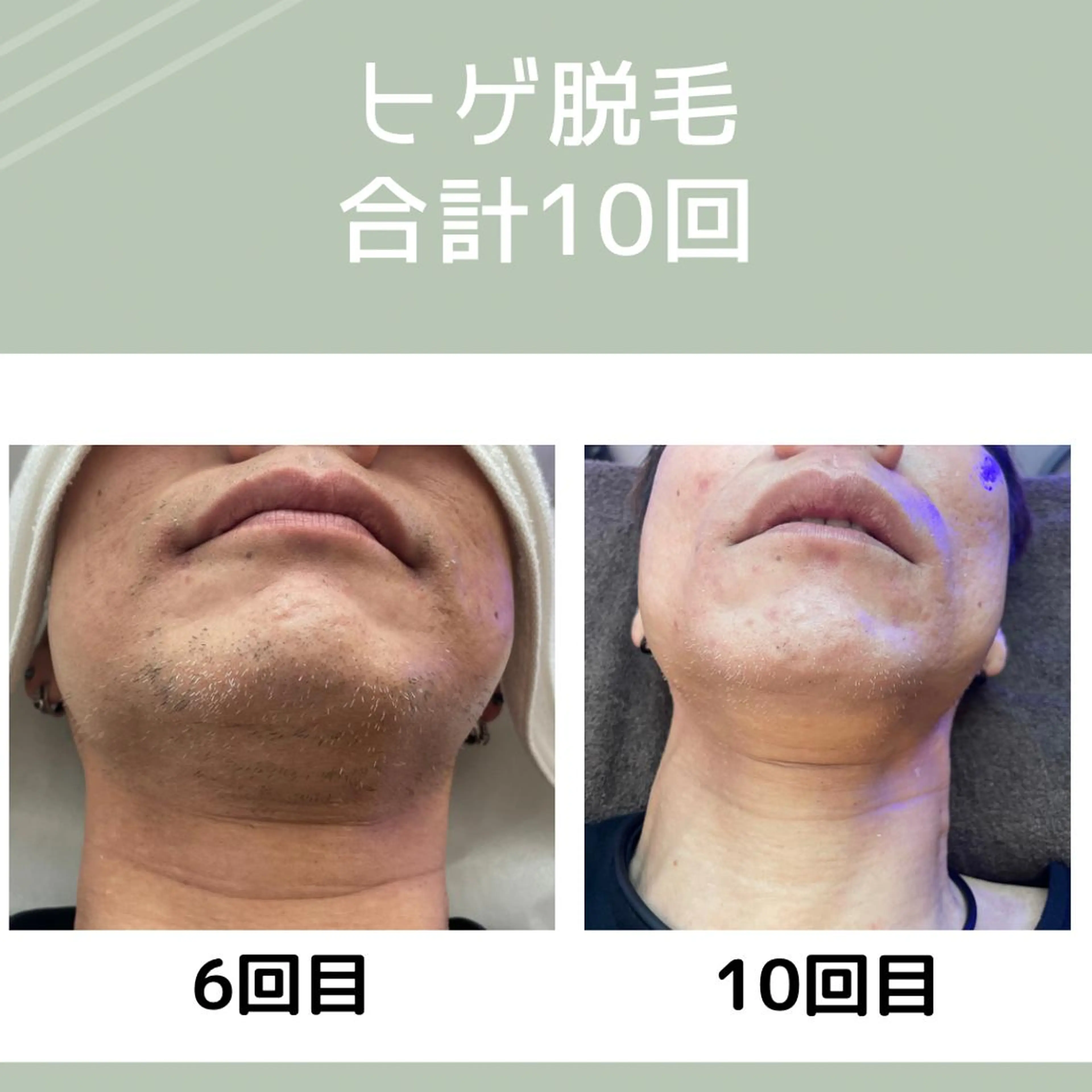 メンズ 脱毛 Pono所属・Pono （ポノ）のその他イメージ