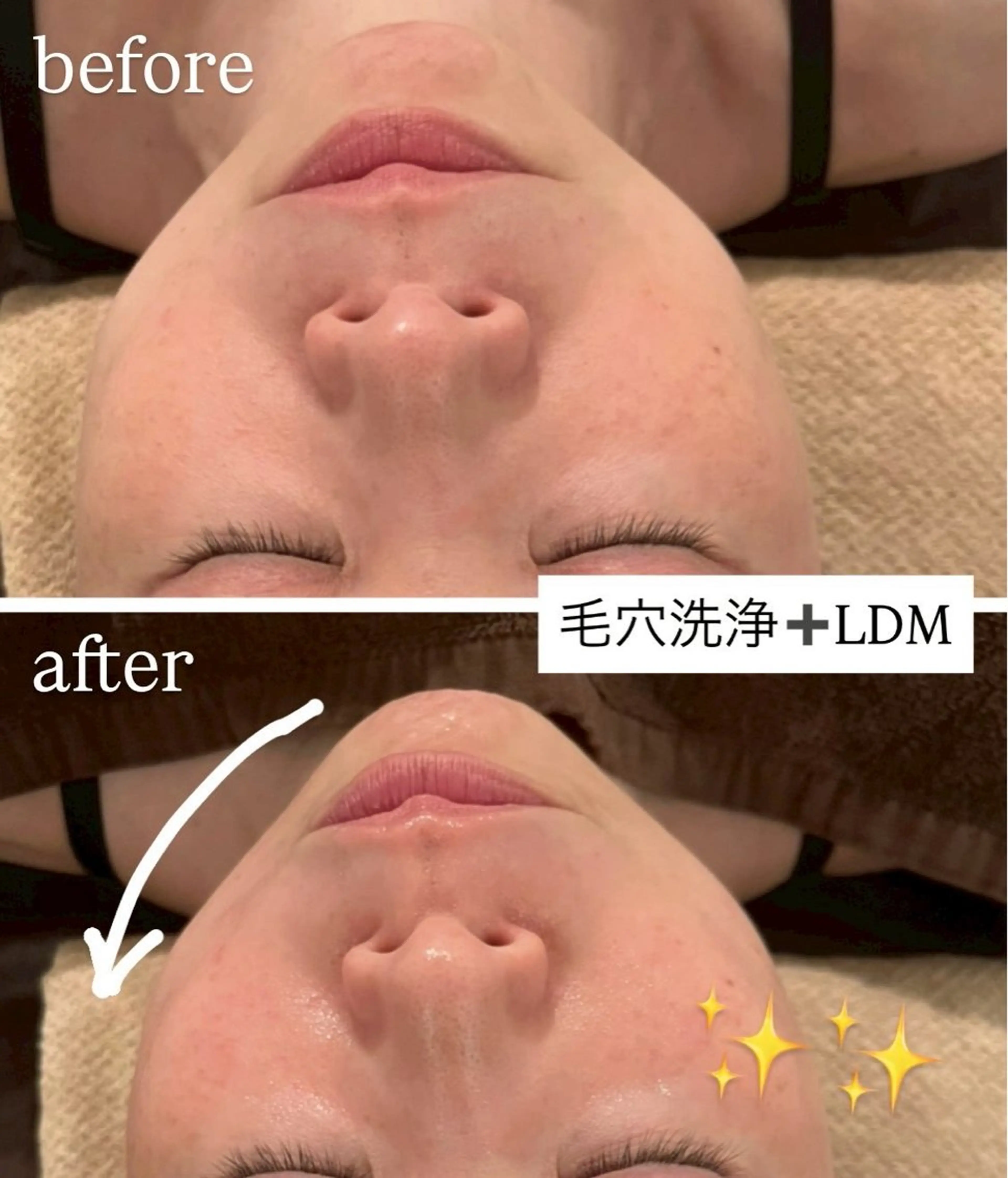 【韓国式美肌】LDM水玉リフティング🫧引き締め小顔✨の写真