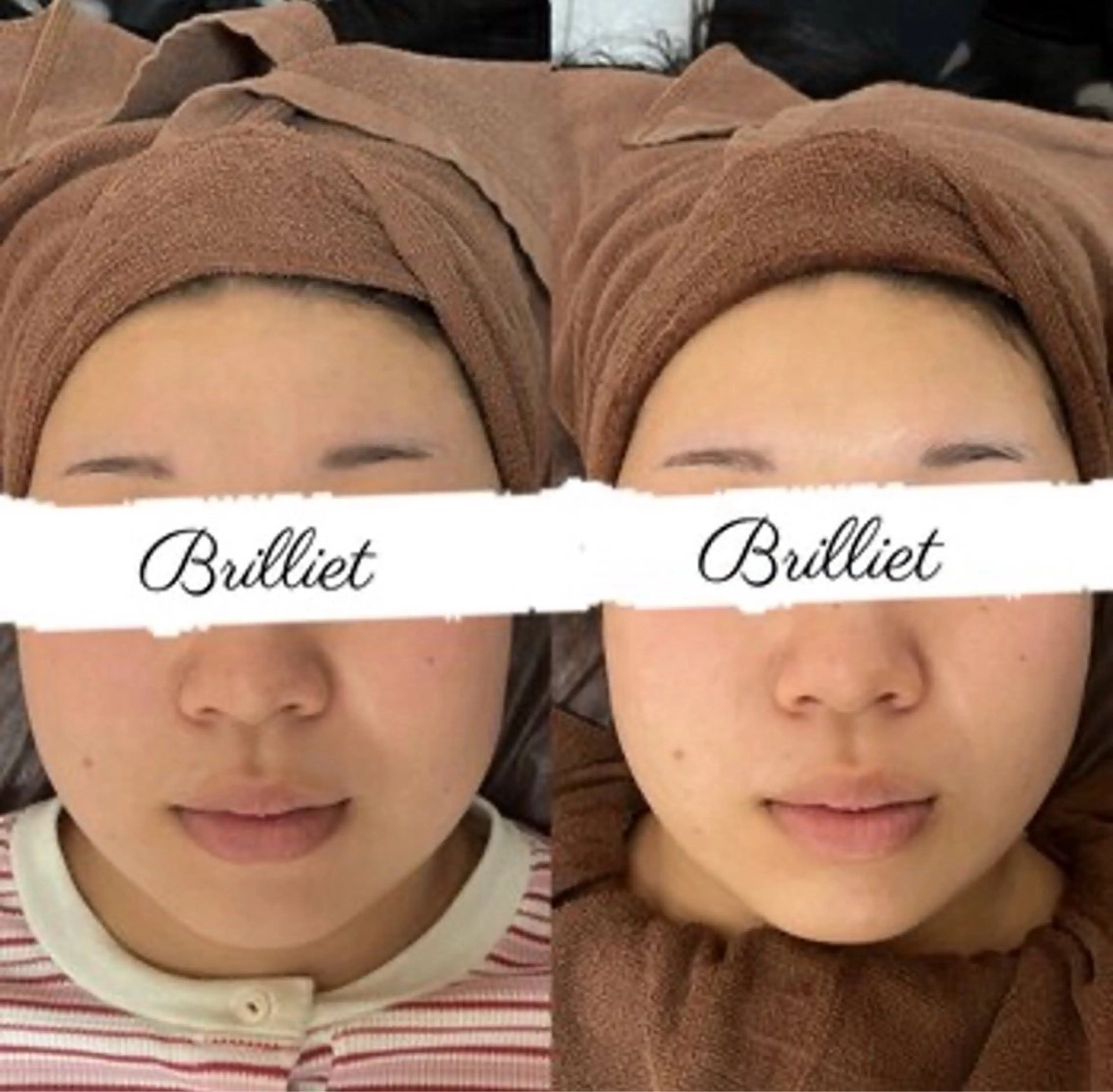 小顔リフトアップ✨シンプルコースの写真