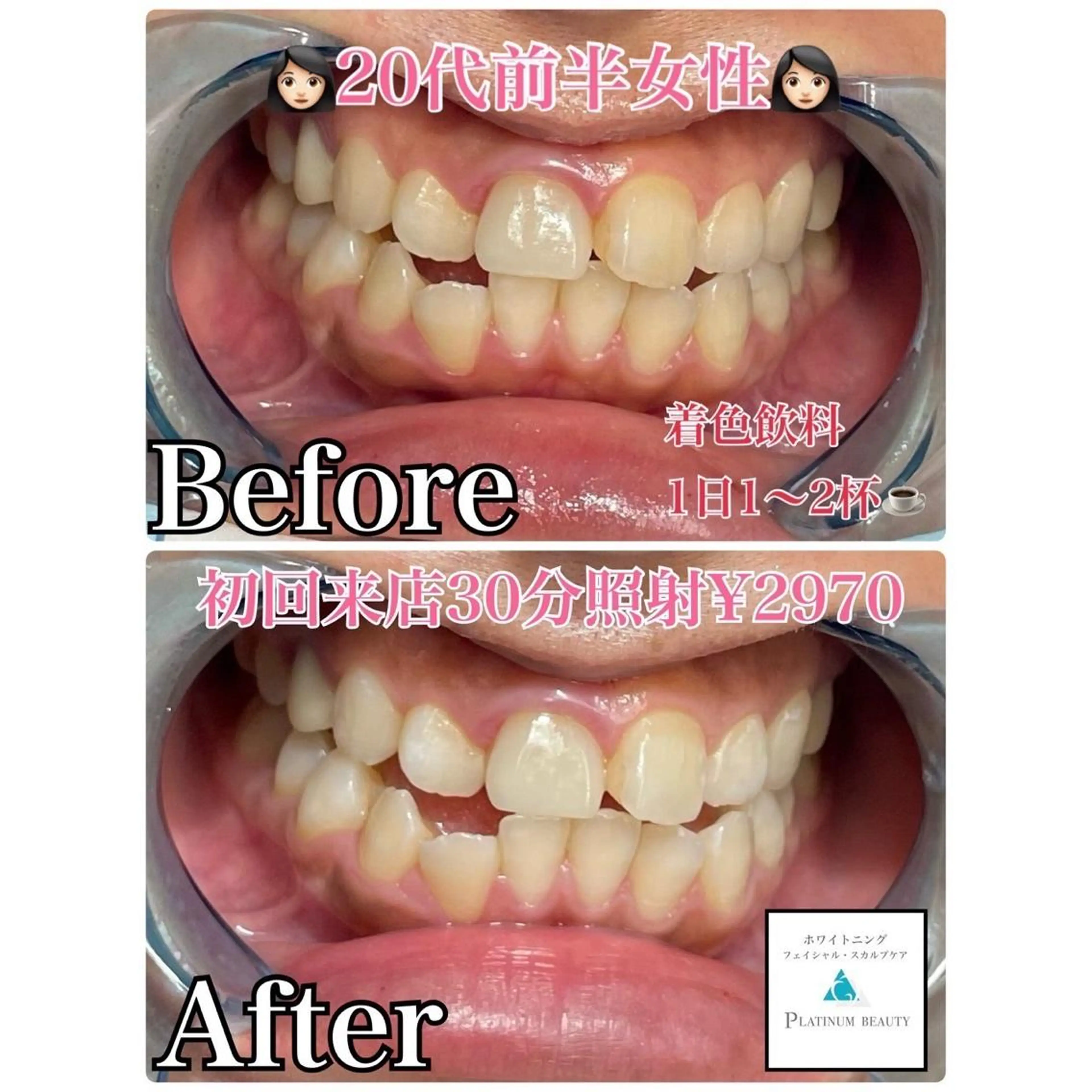 《初回限定》未経験の方、まずは試して見たい方にオススメ★ハイパワーセルフホワイトニング〈15分×2回照射〉の写真