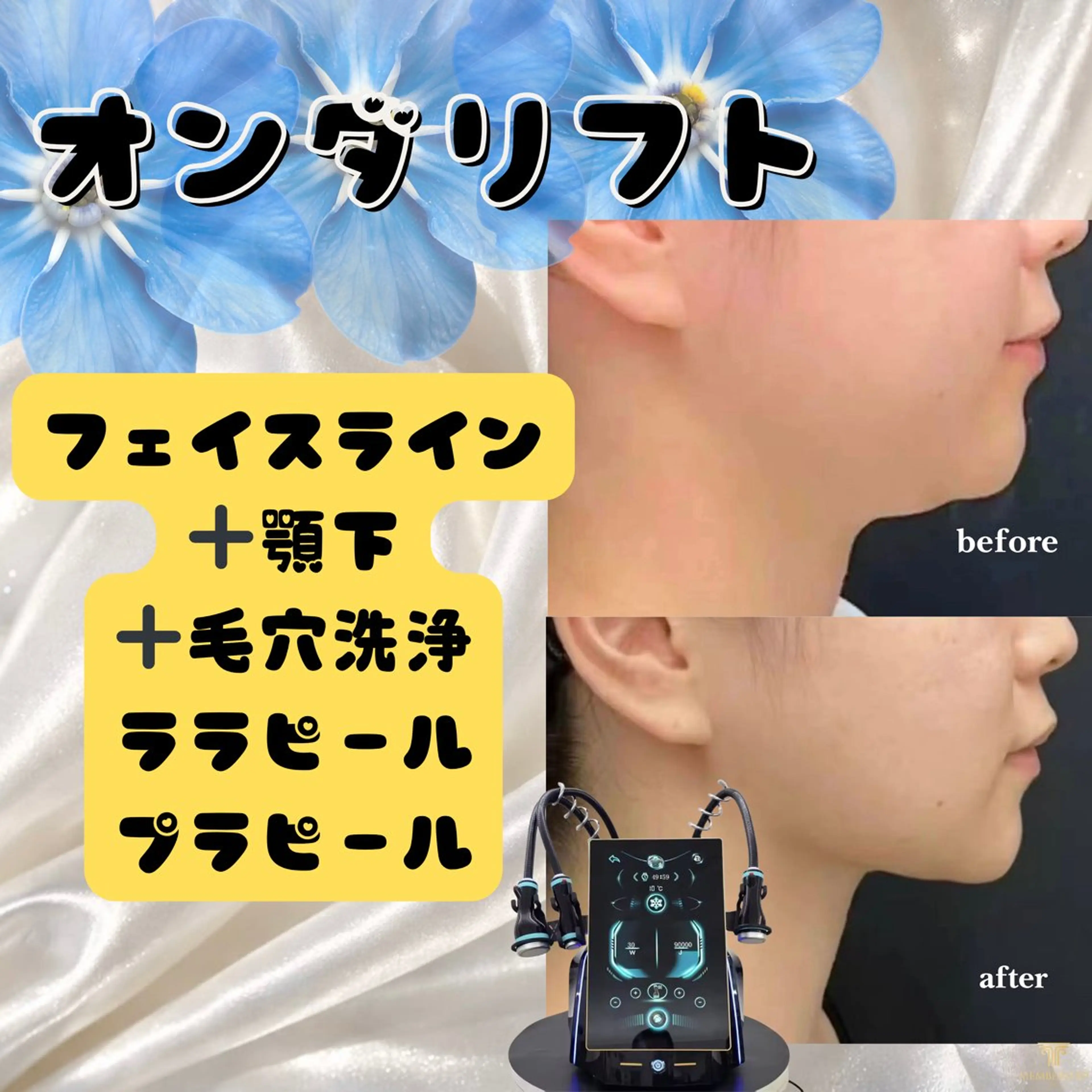 オンダリフト25分｜フェイスライン顎下80kj~140kj＋鼻の毛穴洗浄＋ララピールorプラピールの写真