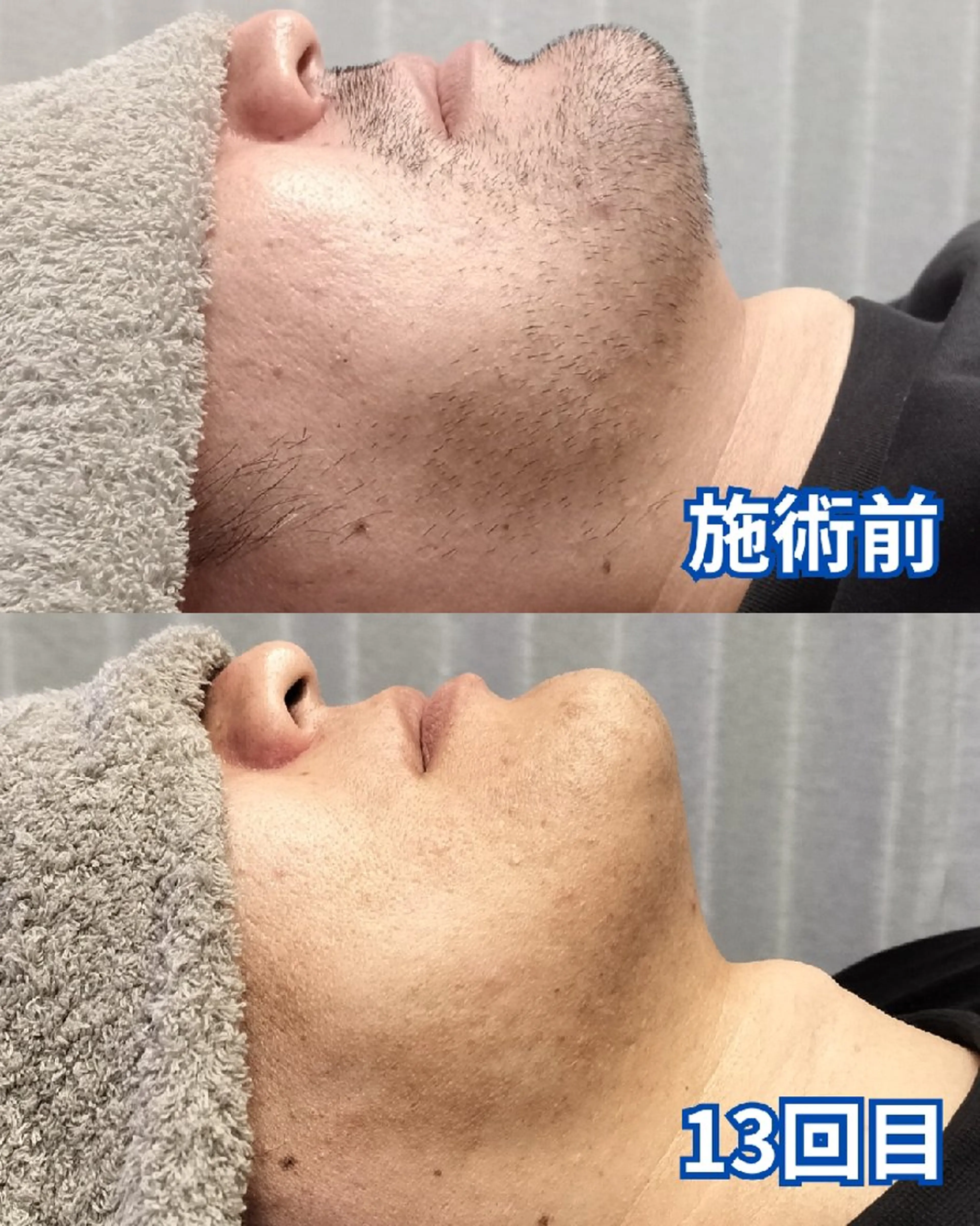 メンズ 脱毛 メンズ脱毛専門店Oceans所属・メンズ眉毛・脱毛専門 Oceansの眉毛・アイブロウイメージ