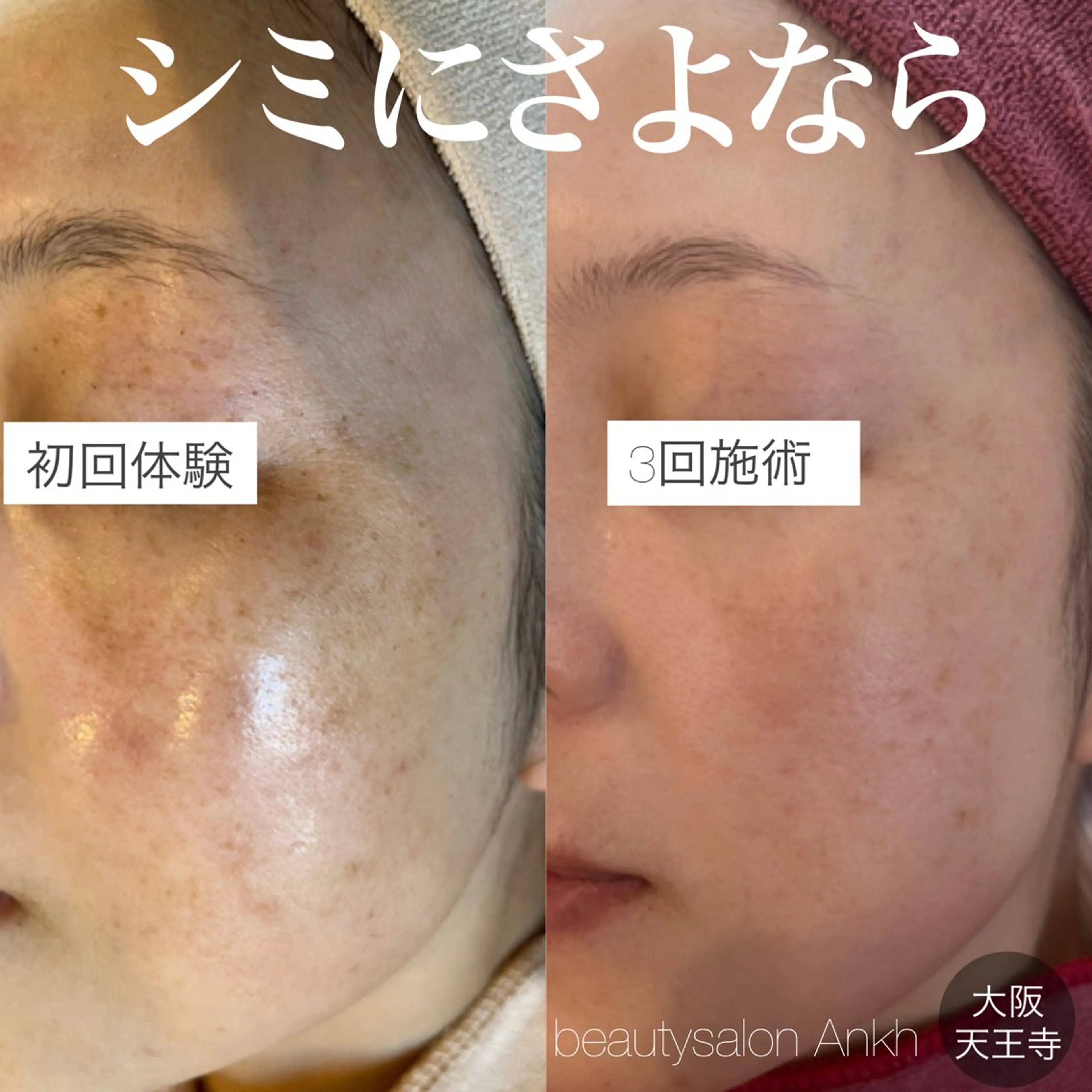 【しみ毛穴専門店】beautysalon Ankh所属・しみ毛穴専門店 Ankh 平田のエステ・リラクイメージ