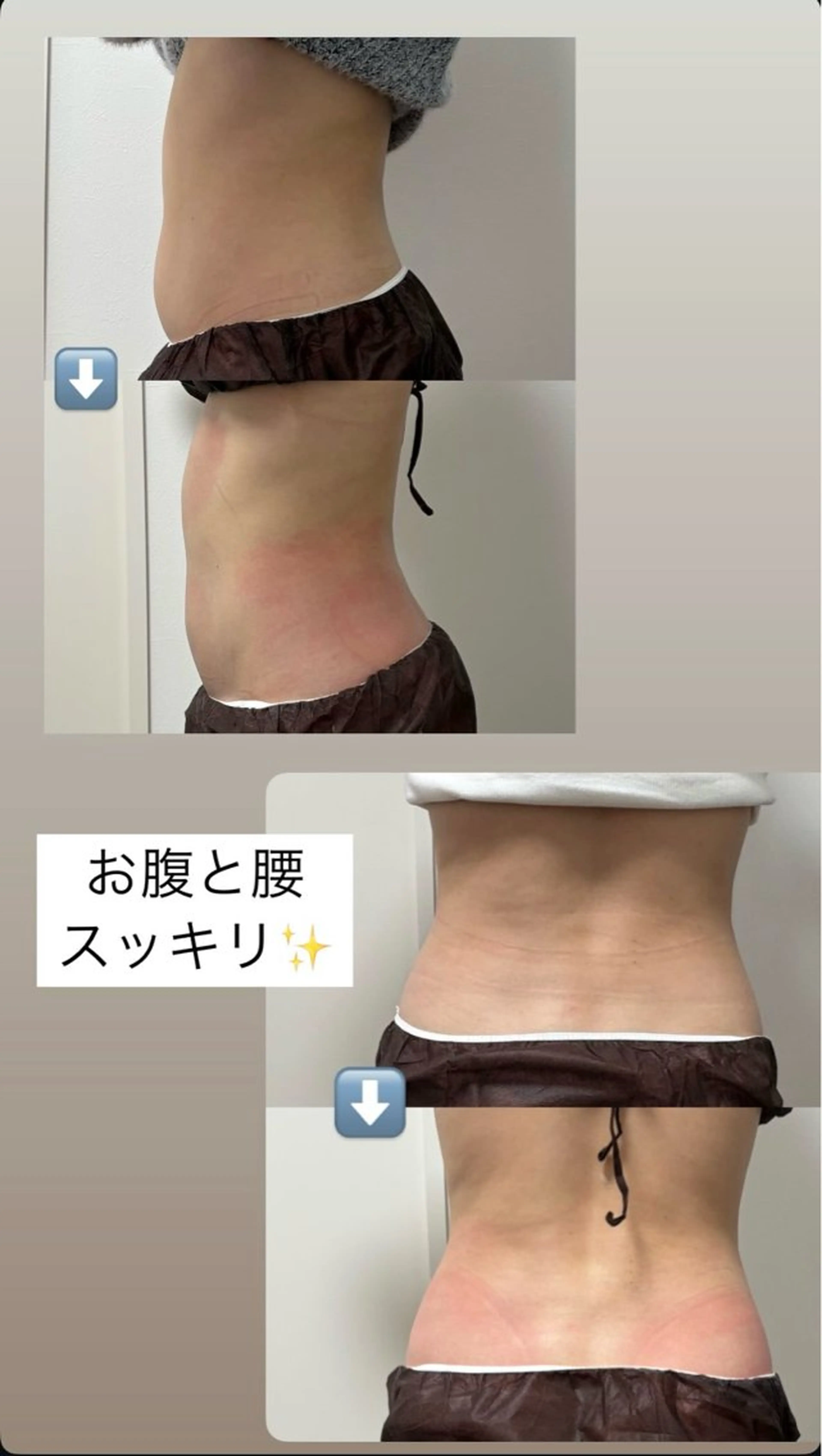 エステ Miiju.所属・Miiju. 石巻市 脂肪冷却  鈴木のエステ・リラクイメージ