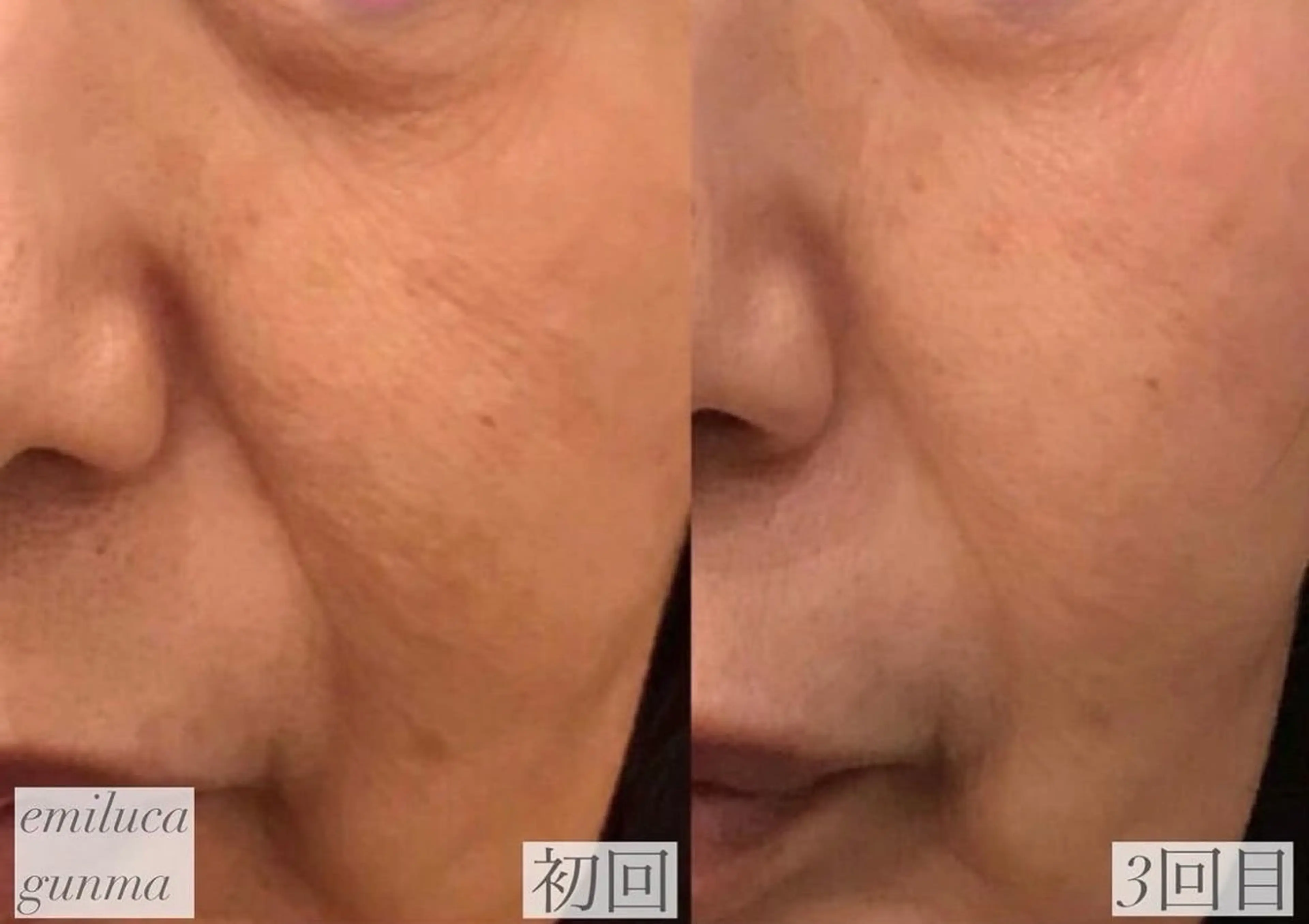 エステ EARTH coiffure beaute 新潟紫竹山店所属・🤍アベシュリ /フェイシャル🤍のエステ・リラクイメージ