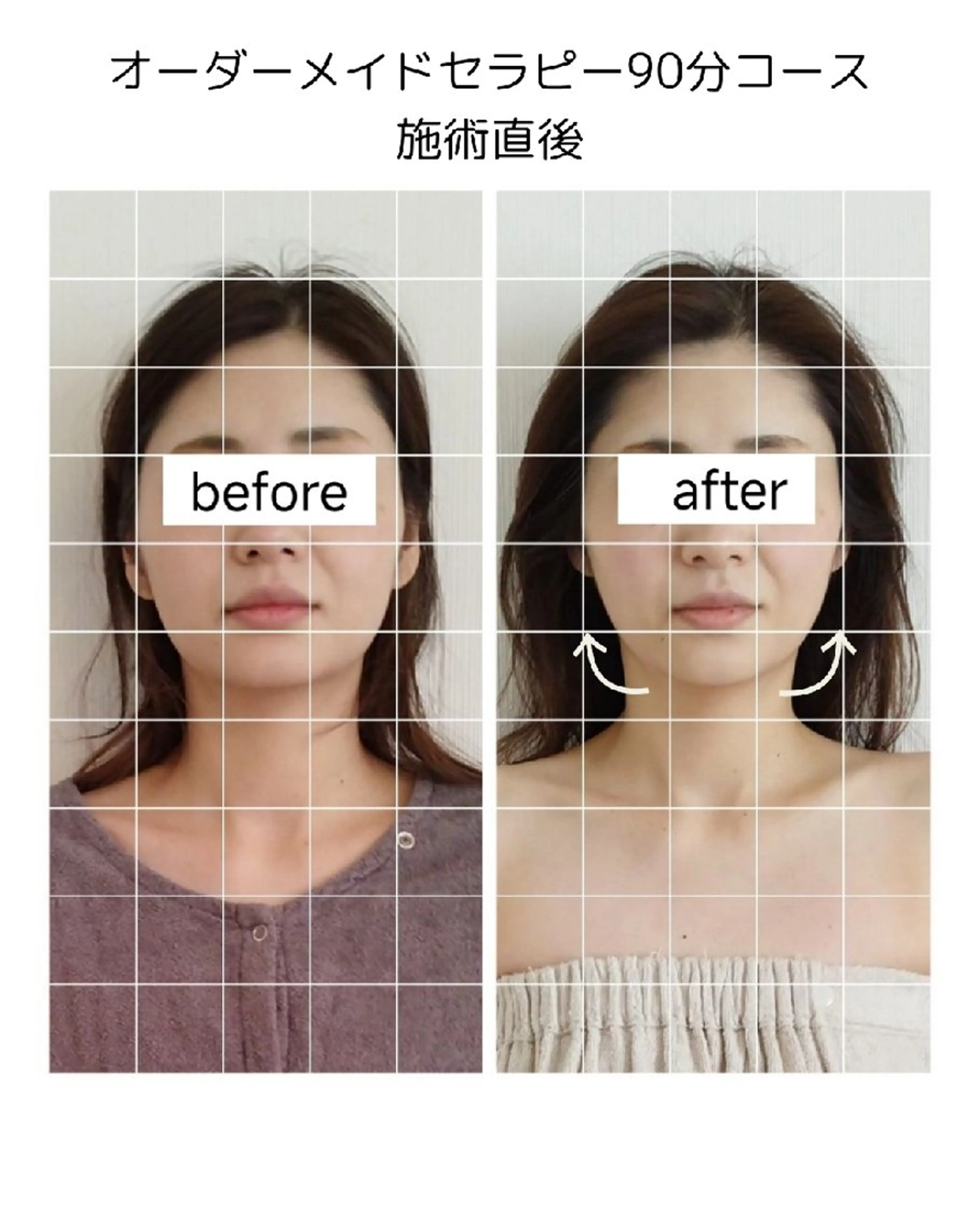 小顔矯正【左右差／たるみ改善】顔メニュー人気No.1の写真