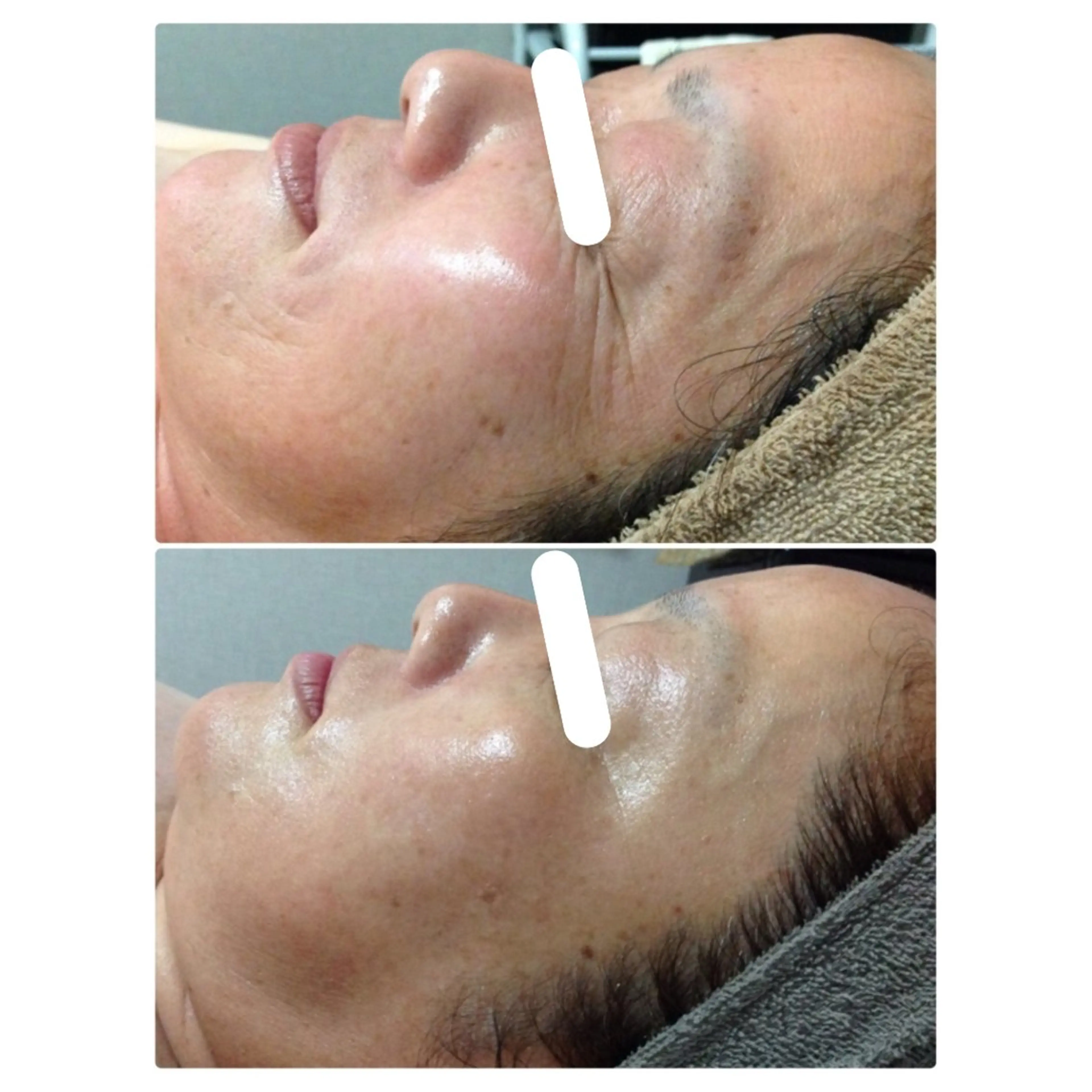 人気No. 1《シワ/たるみ/美白》−5歳肌トリートメント【リアボーテ　タラソトリートメント】の写真