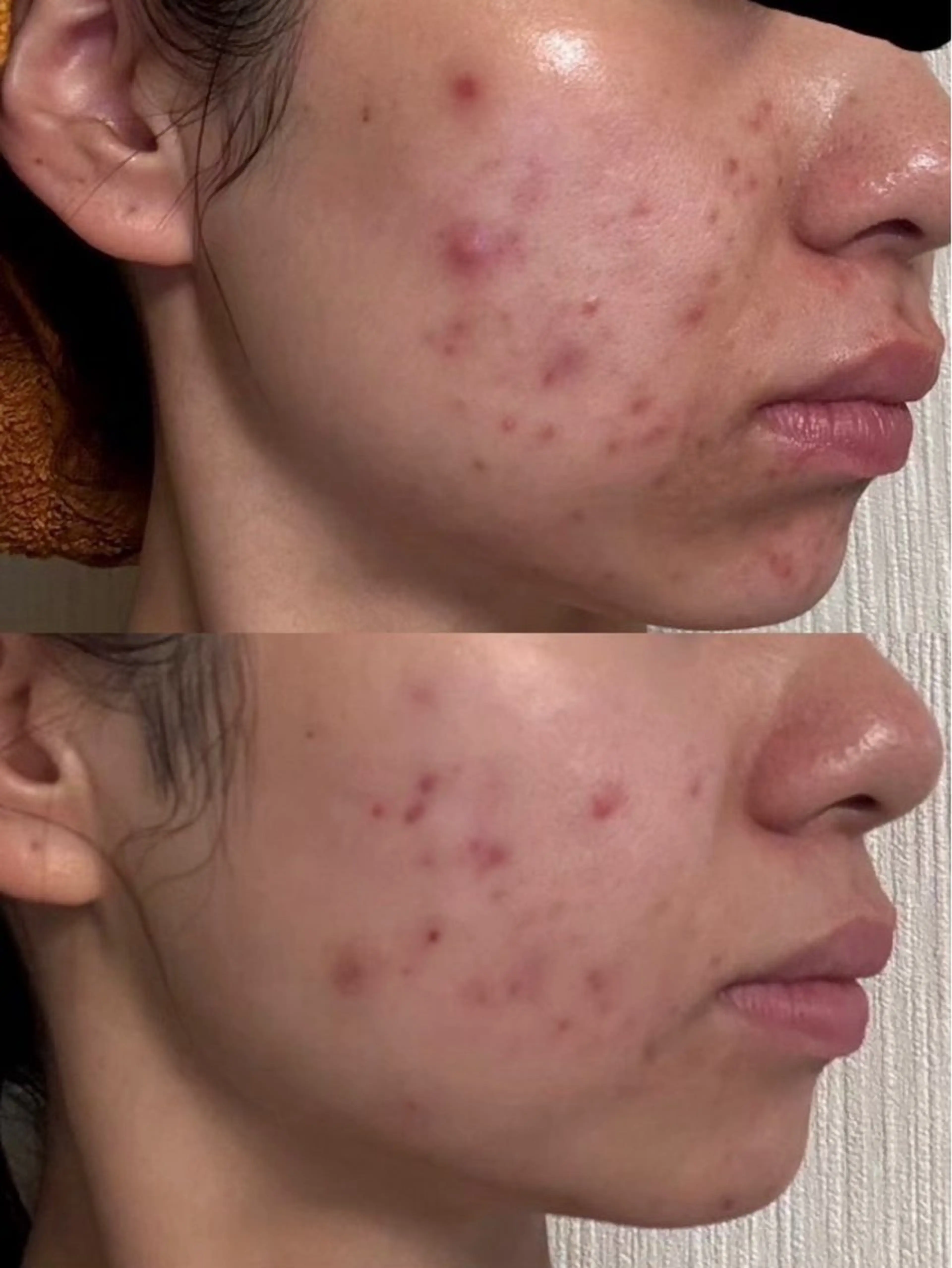 【医療提携】幹細胞艶玉ハーブピーリング　glow所属・肌質改善専門 【医療提携】glowのエステ・リラクイメージ