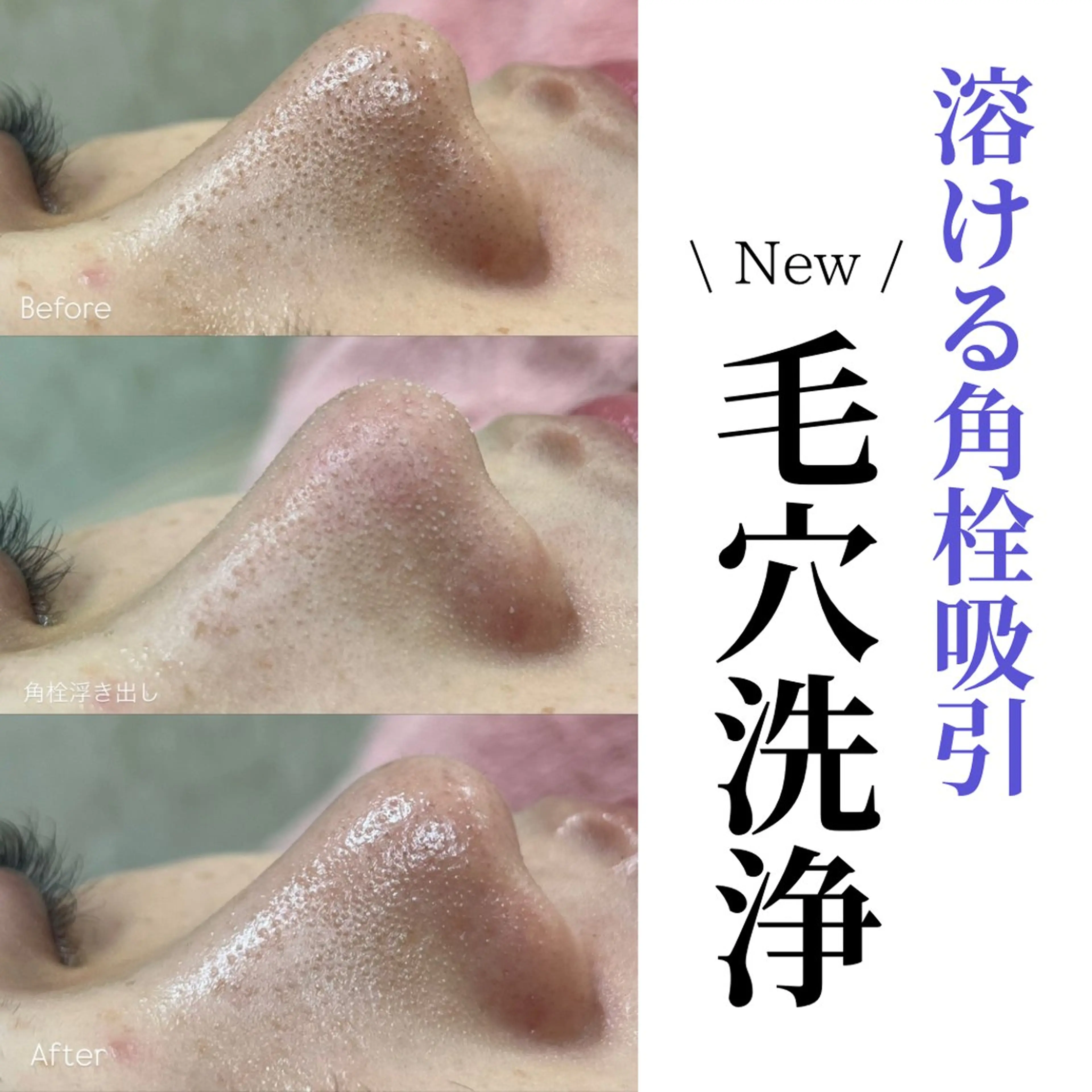 【 溶ける毛穴吸引&洗浄 】 角栓の溜まりやすい (鼻・顎・眉間)部分集中ケア 💁🏻💡 ¥5,980の写真