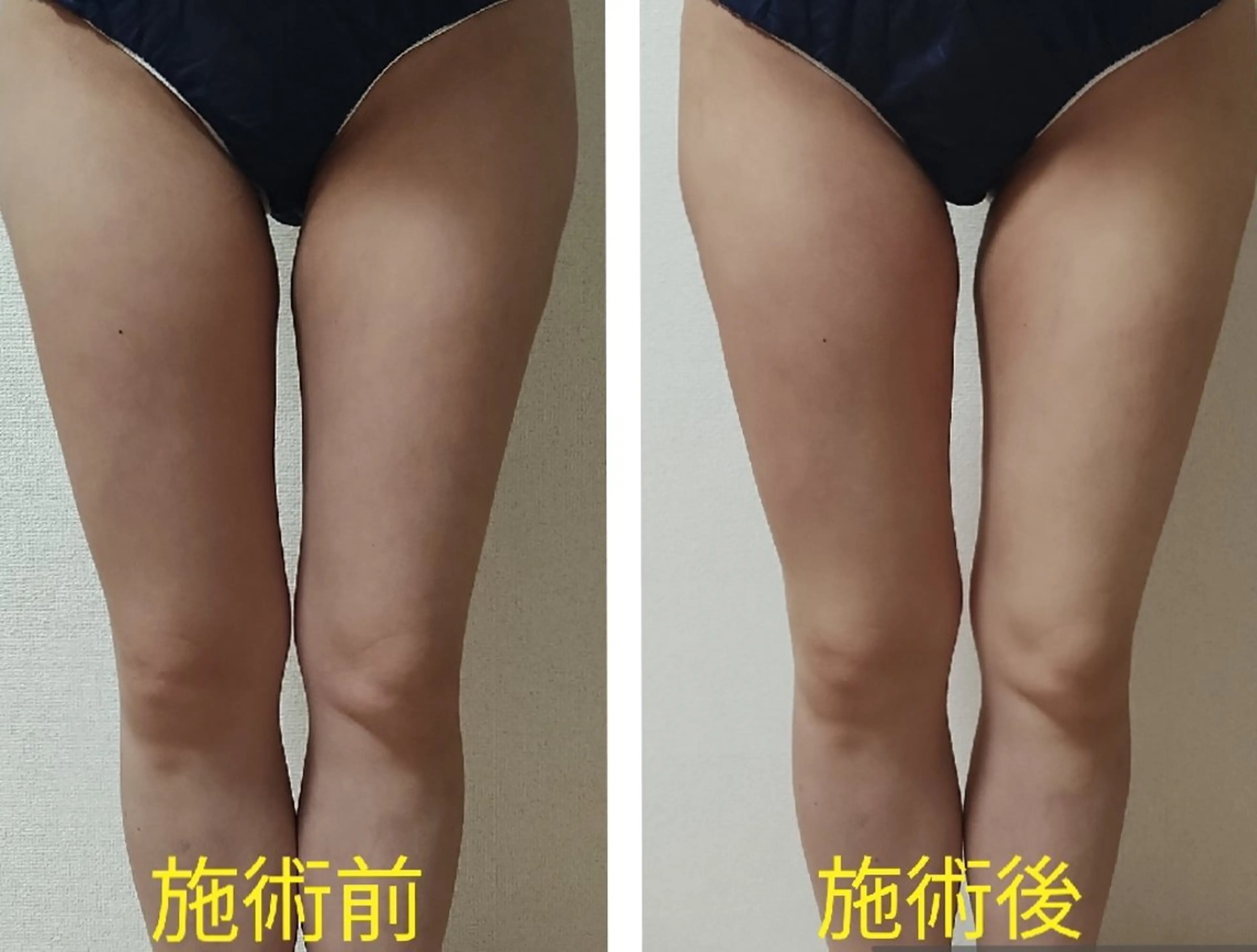 20分間引き締め痩身🍀お試し1箇所✨の写真