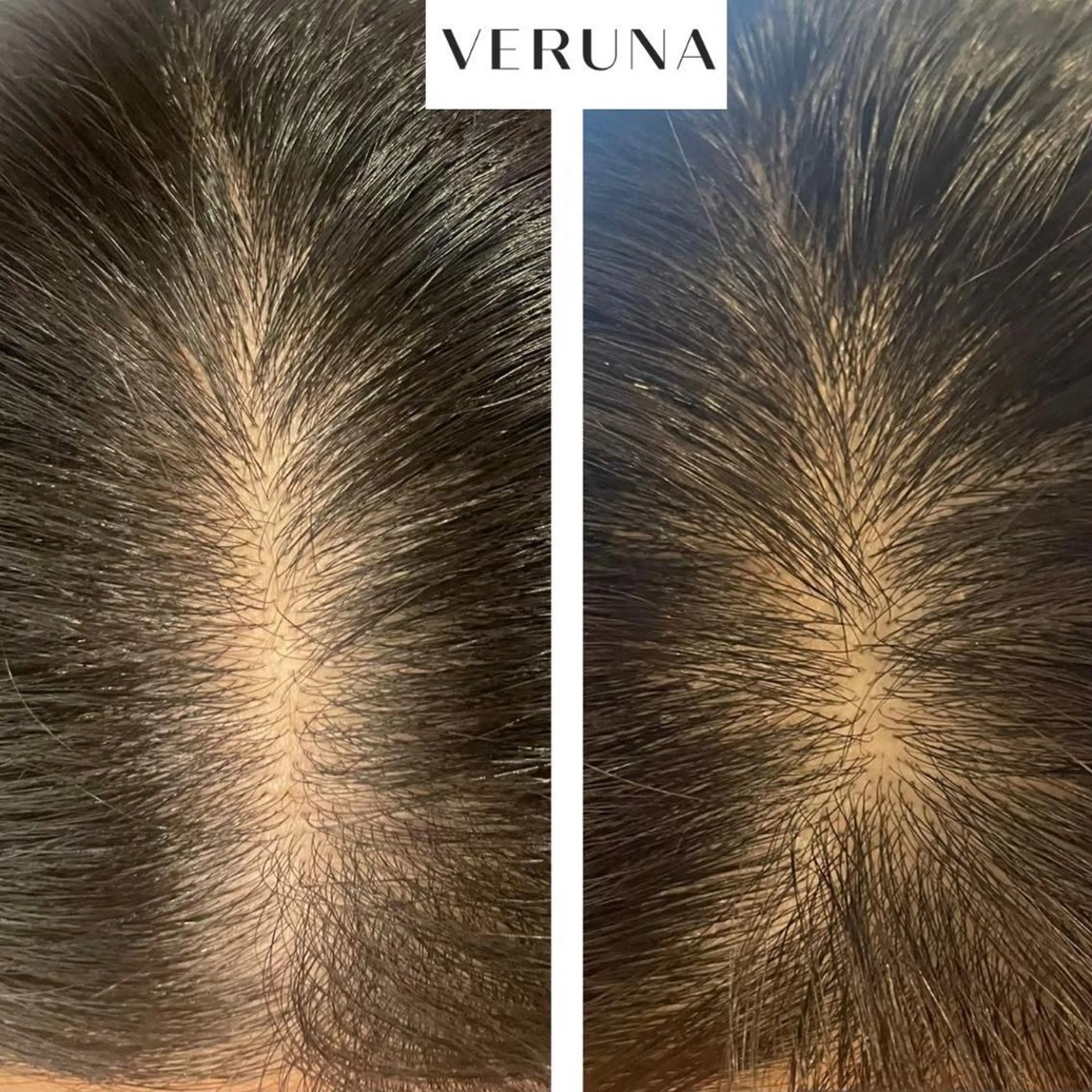 モニター様募集‼️髪・頭皮の悩みに✨VERUNAスカルプケア(ご希望箇所へのスポット施術)〈剥離あり〉の写真