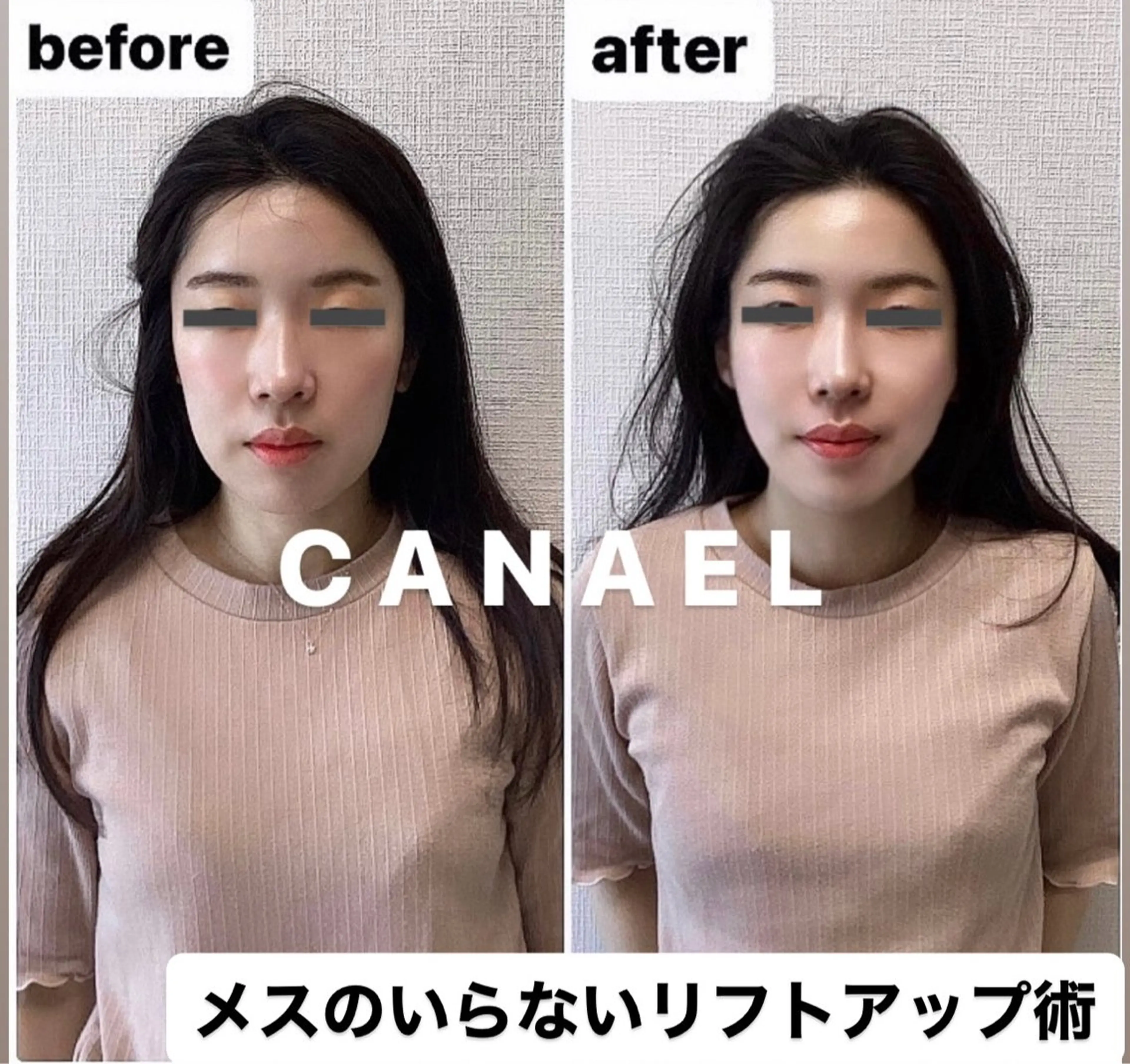 【頭蓋骨/小顔矯正】丸顔/二重アゴ/たるみケア/リフトアップコースの写真