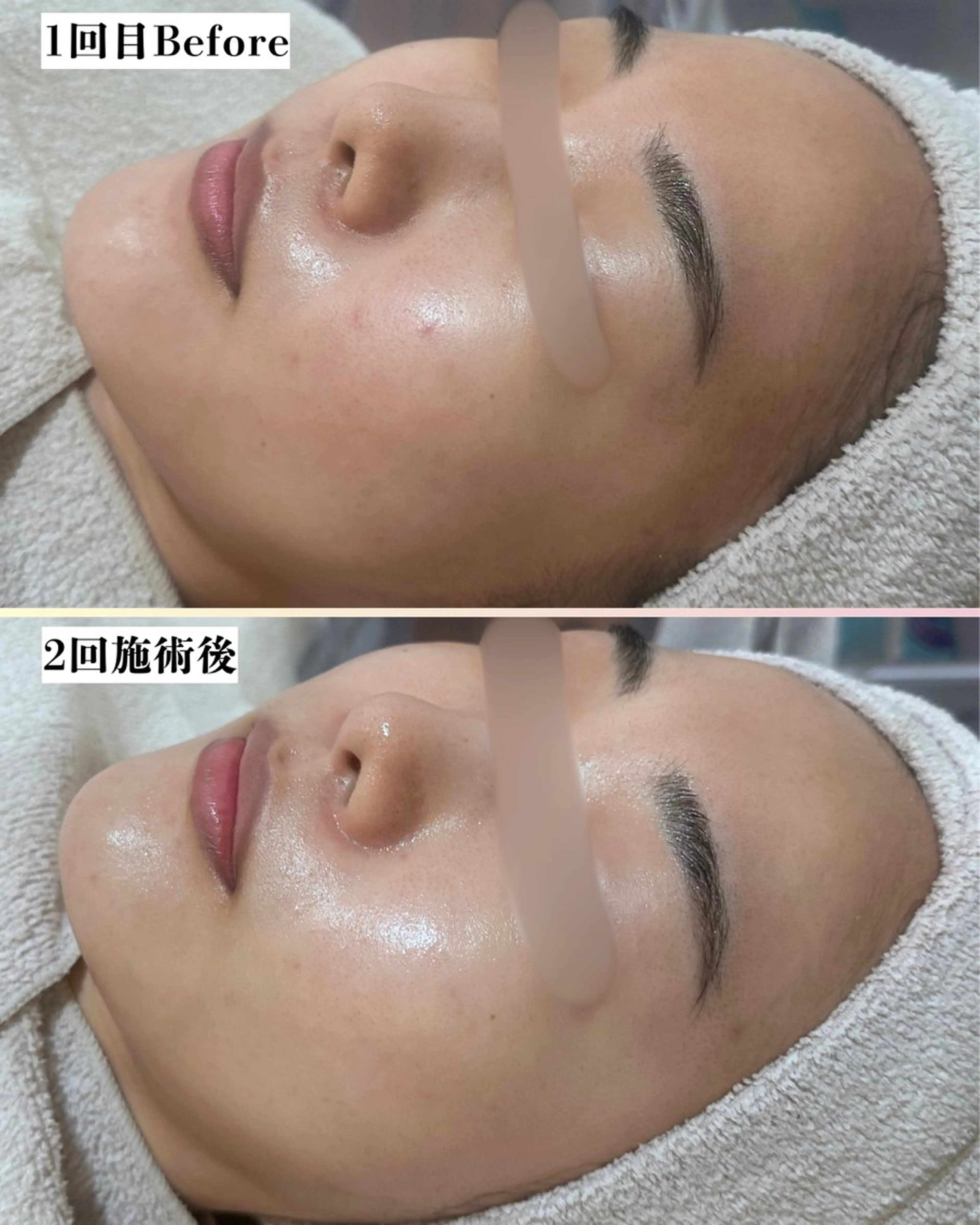 エステ |ピーリング・毛穴| soina神楽坂のエステ・リラクイメージ