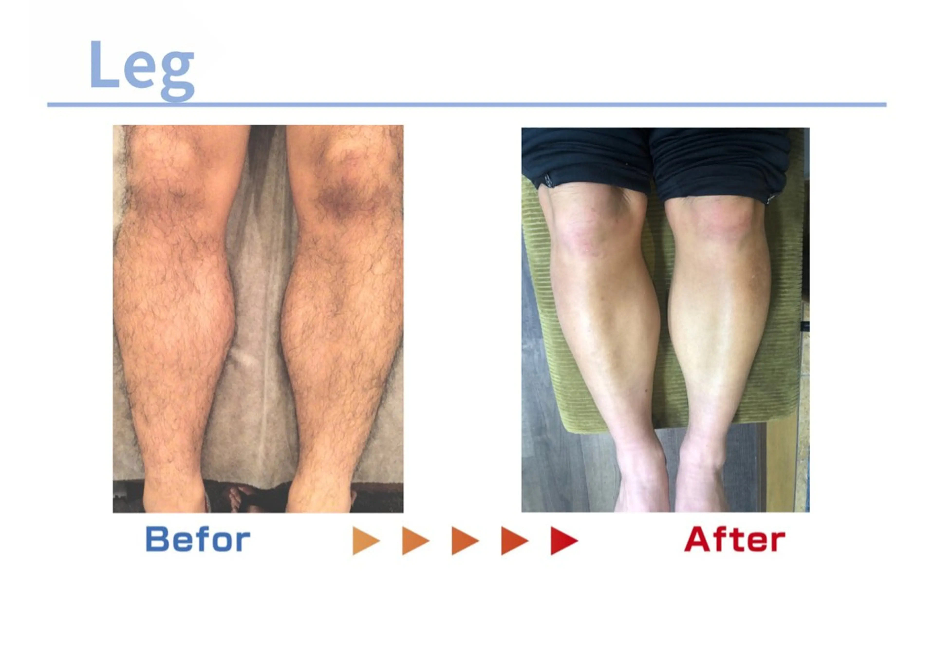 セルフ脱毛/美尻イス キングスサロン熊本のエステ・リラクイメージ