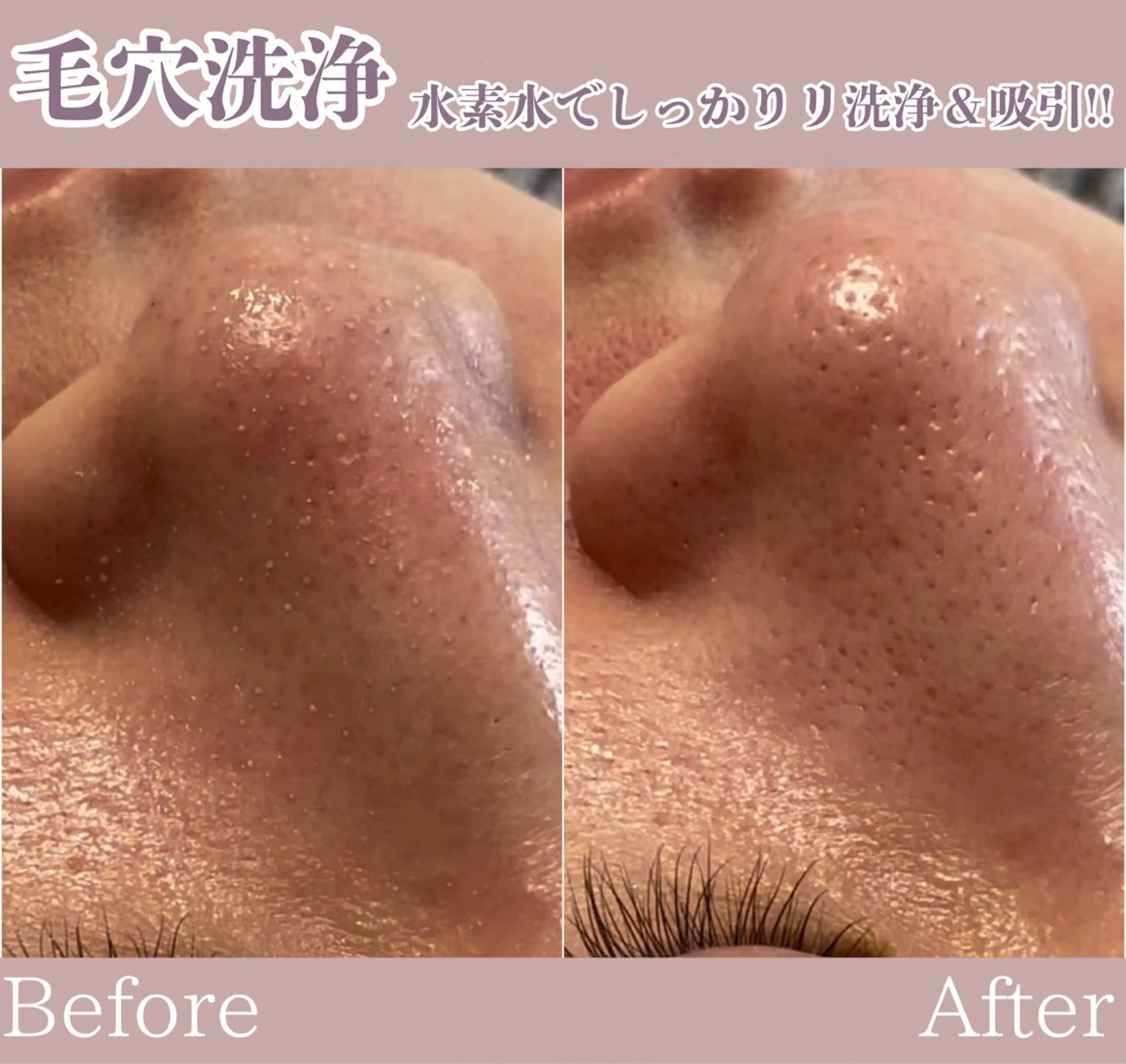 毛穴洗浄1回での効果です!! お鼻に詰まっている角栓を浮かせて吸引・洗浄していきます^^｜RED所属・WAX・肌質改善・毛 穴 洗浄/林愛真のエステ・リラクフォト(20241108120352)｜ミニモ